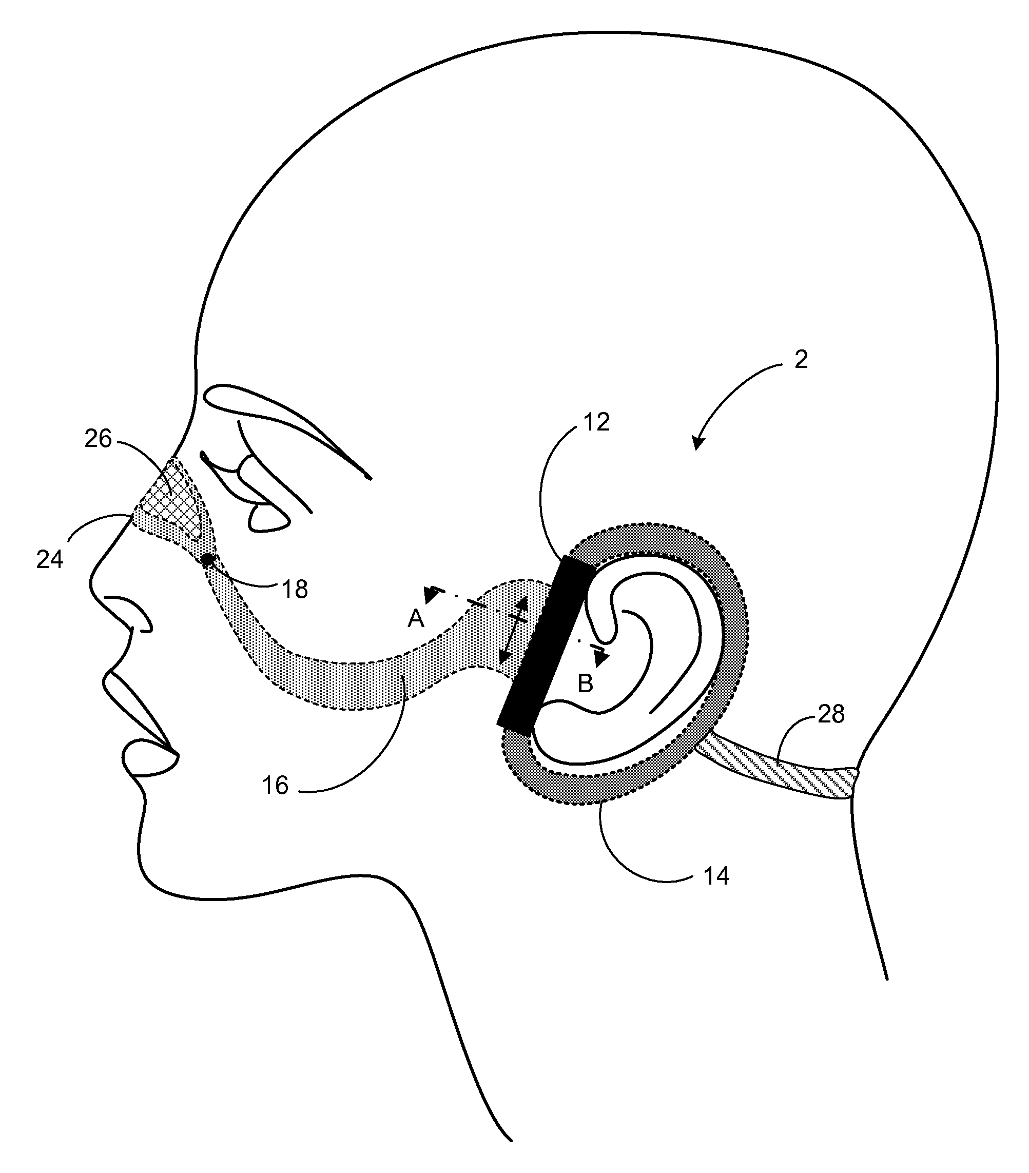 Facial structure stabilization methods and apparatus