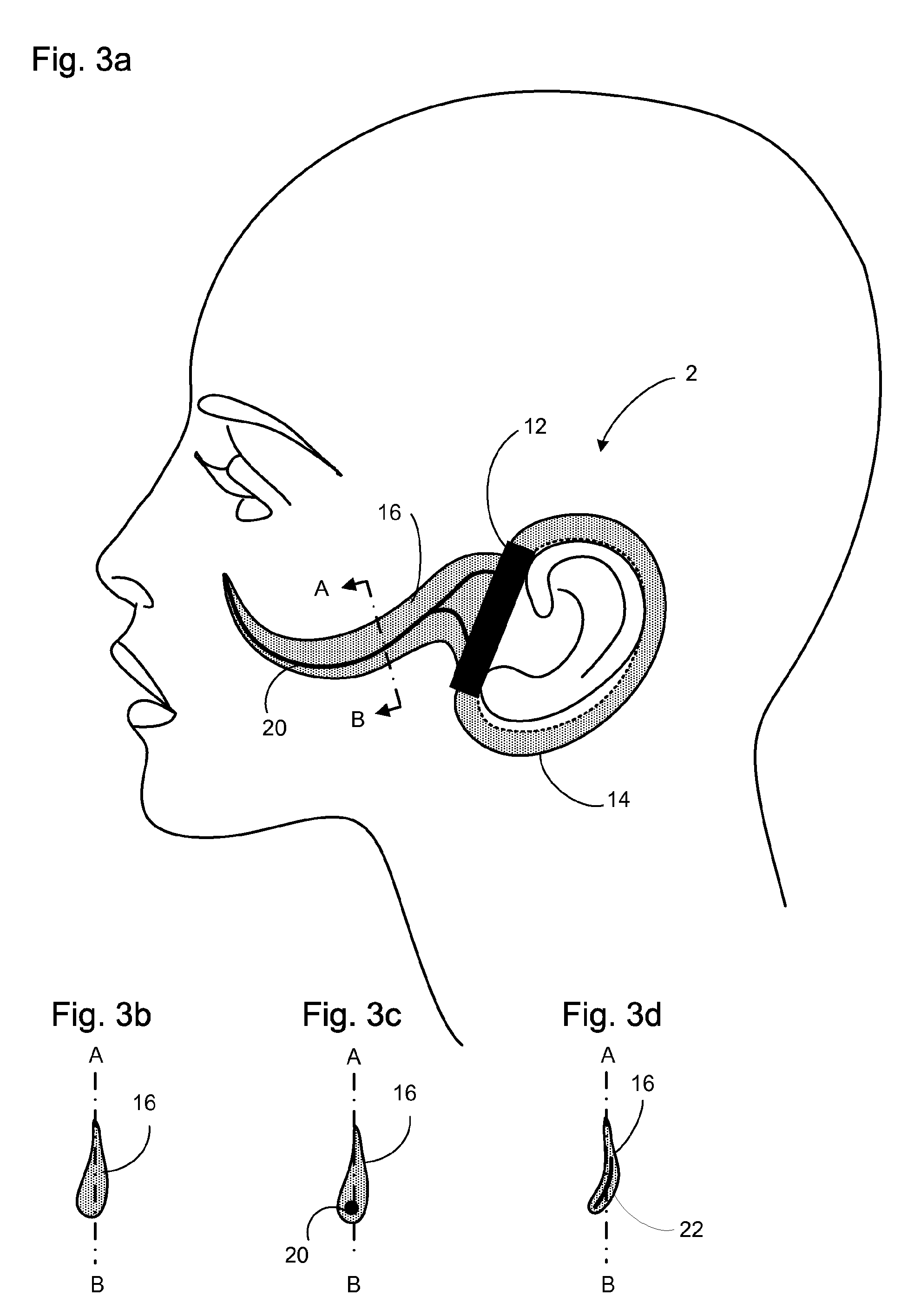 Facial structure stabilization methods and apparatus