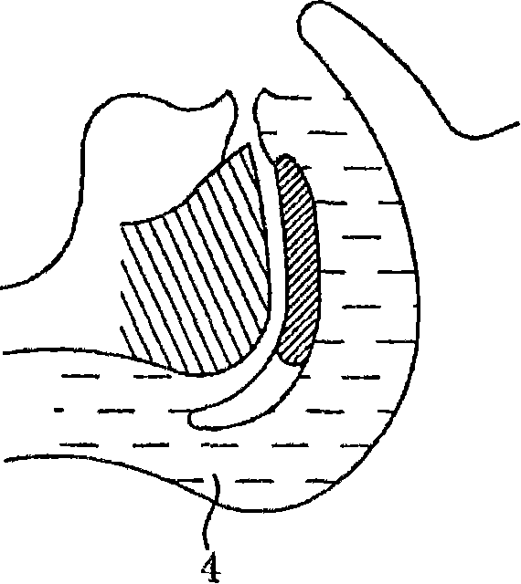 Apparatus for preventing sleeping respiratory obstruction and method using same