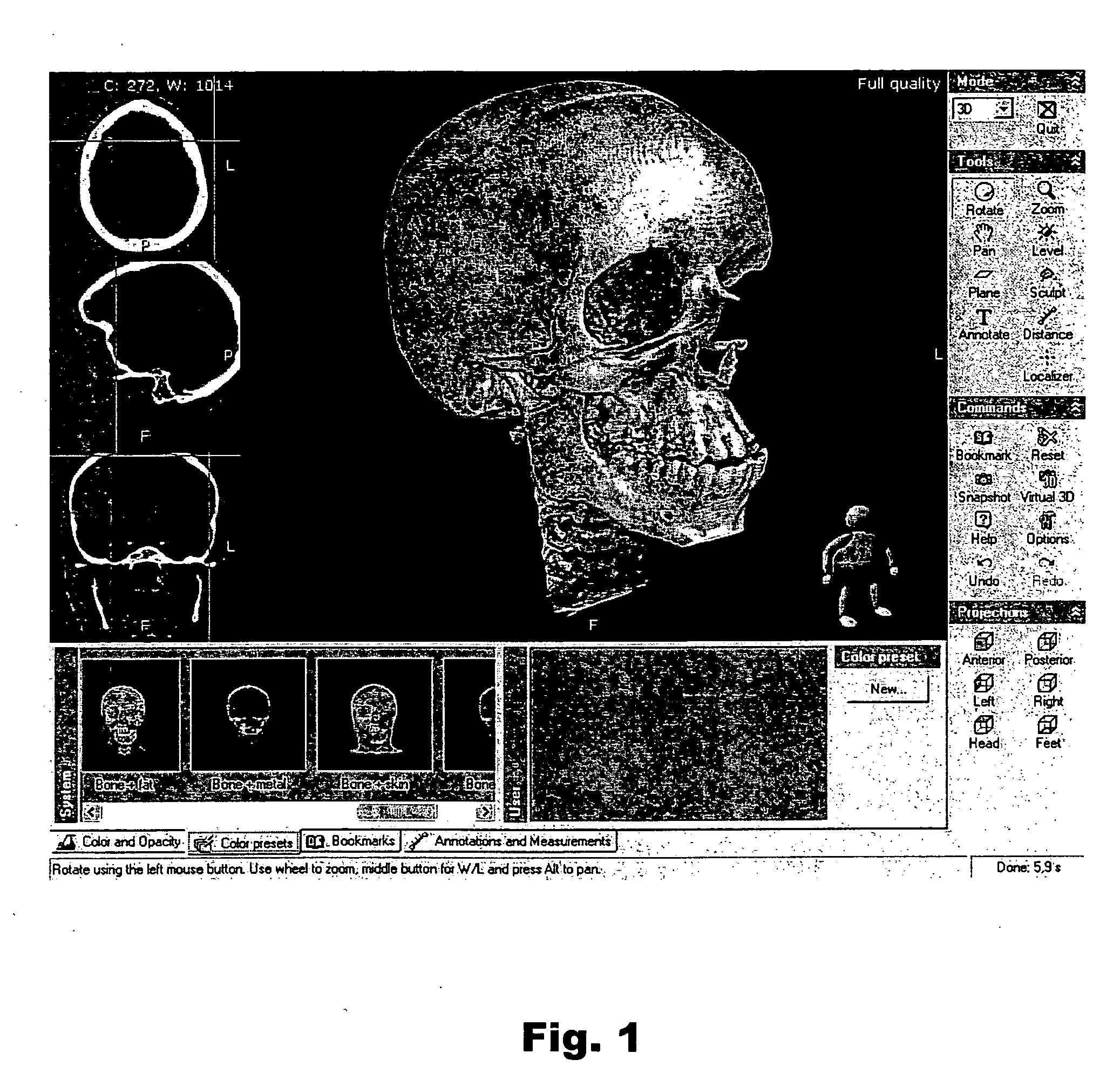 Automated synchronization of 3-D medical images, related methods and computer products