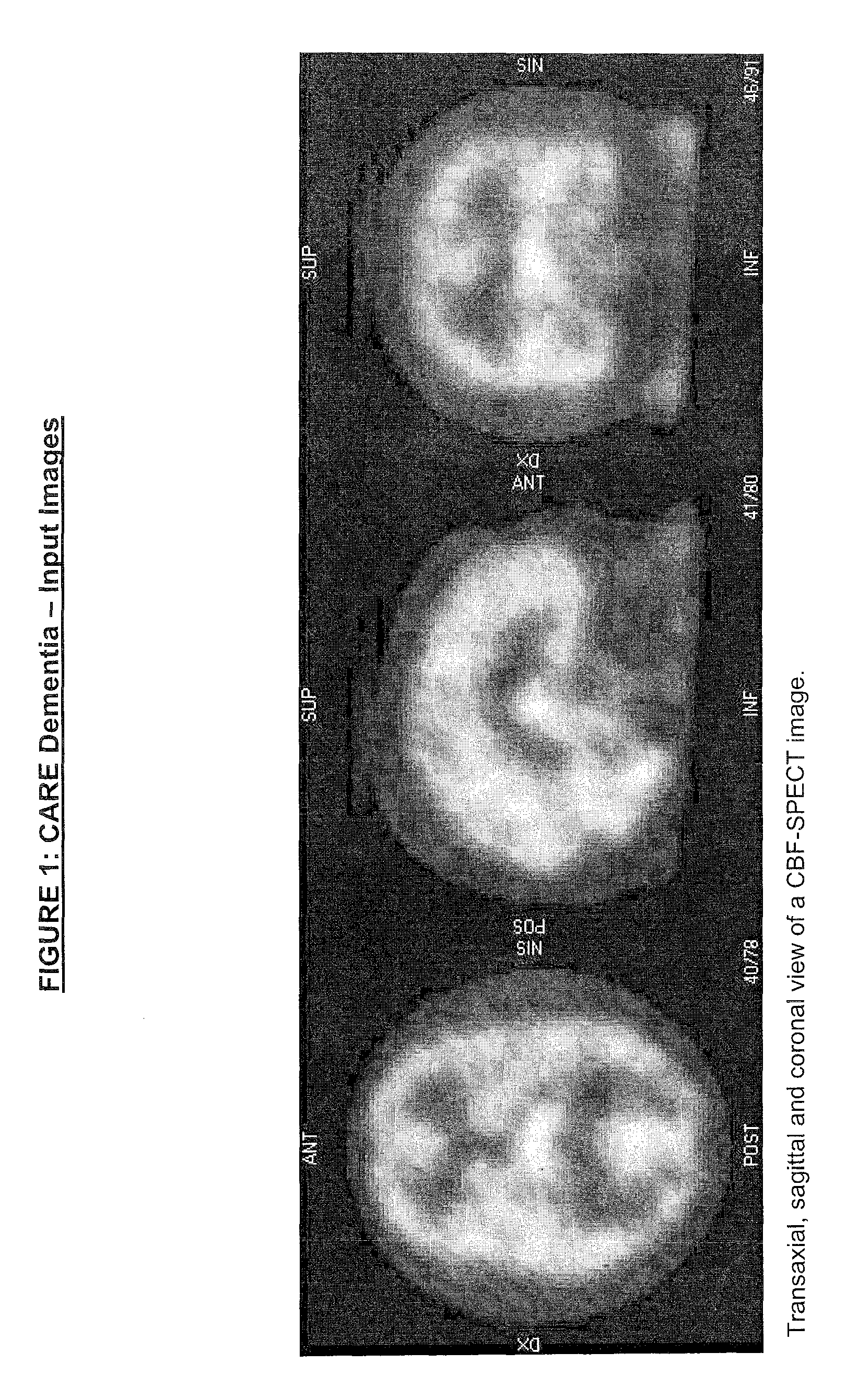 Automatic interpretation of 3-D medicine images of the brain and methods for producing intermediate results