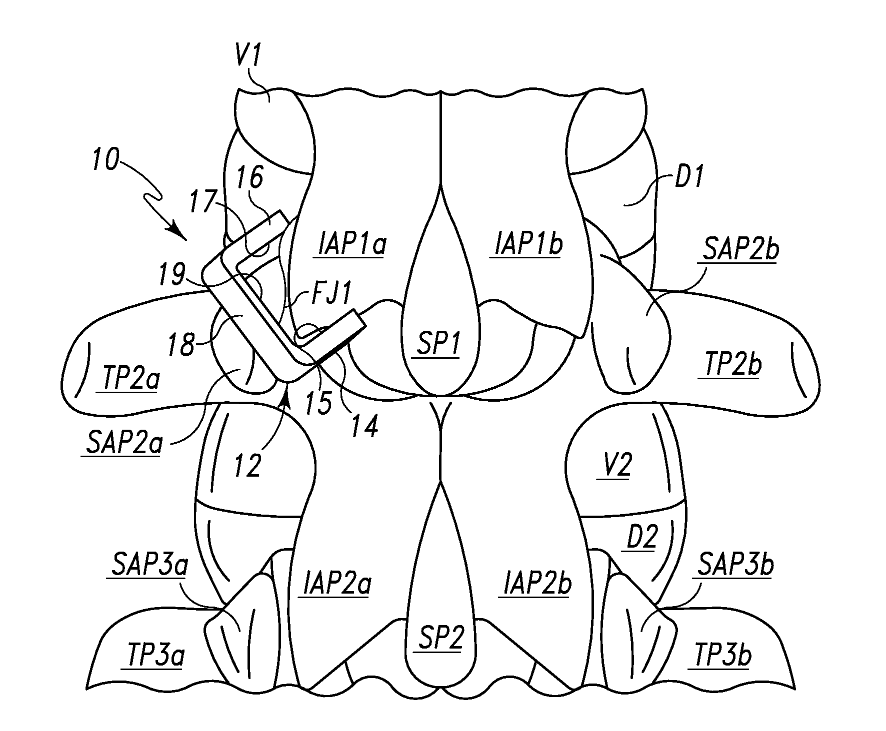 Spinal Facet Fastener