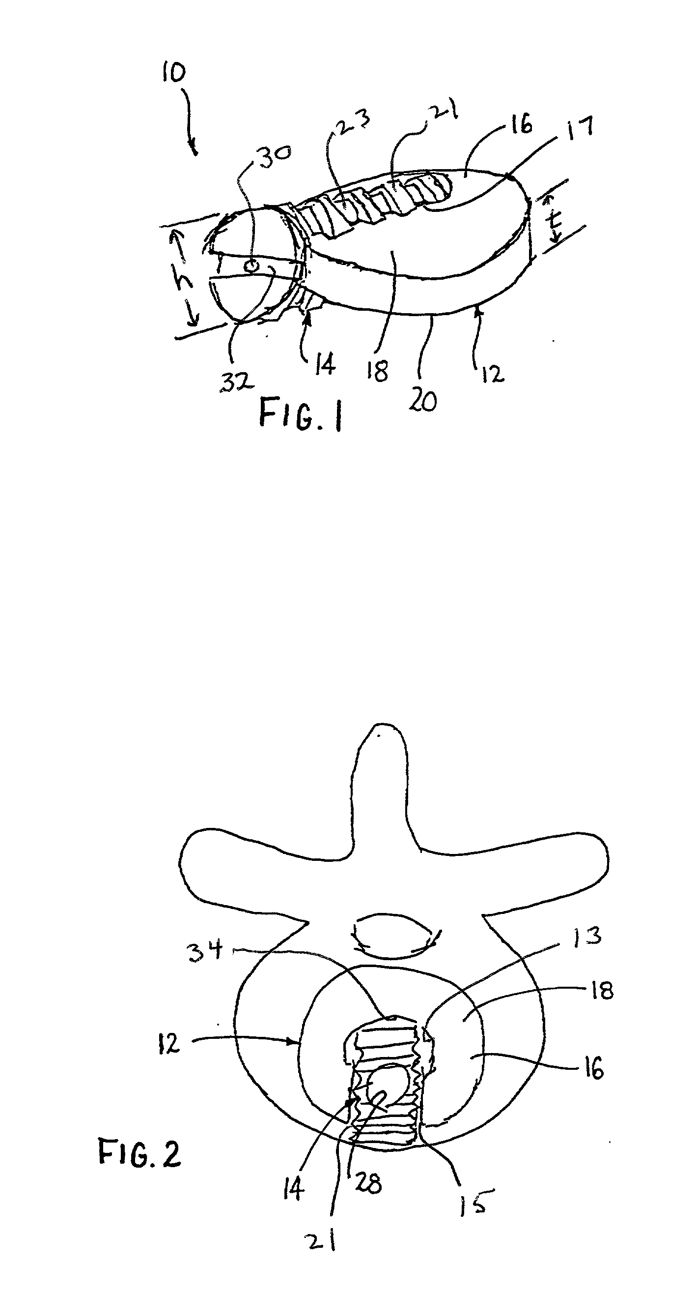 Anterior lumbar spacer