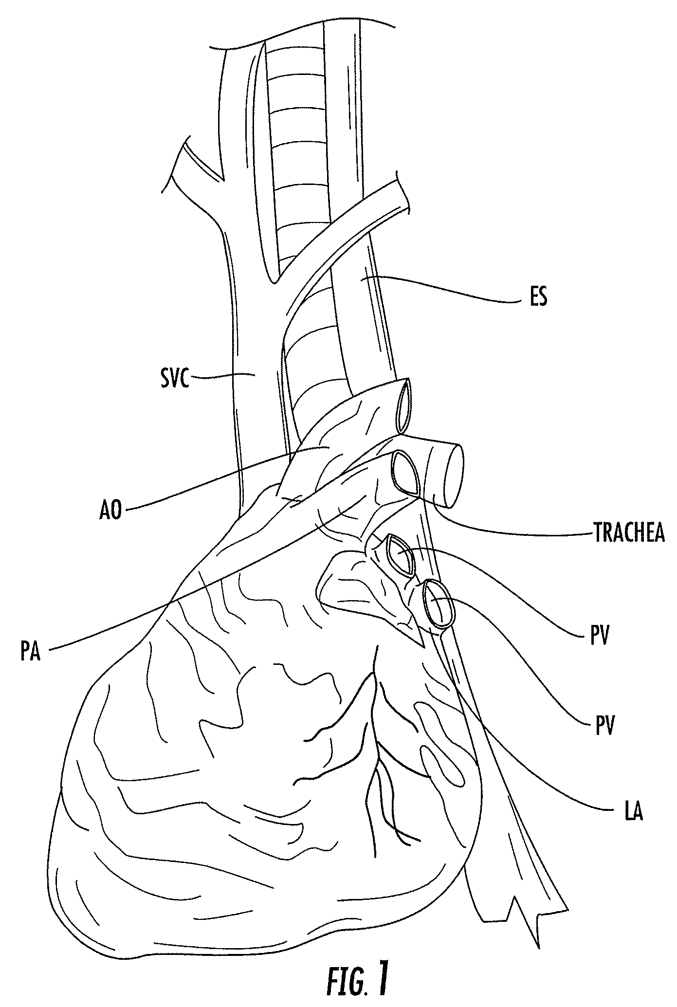 Nasogastric tube for use during an ablation procedure