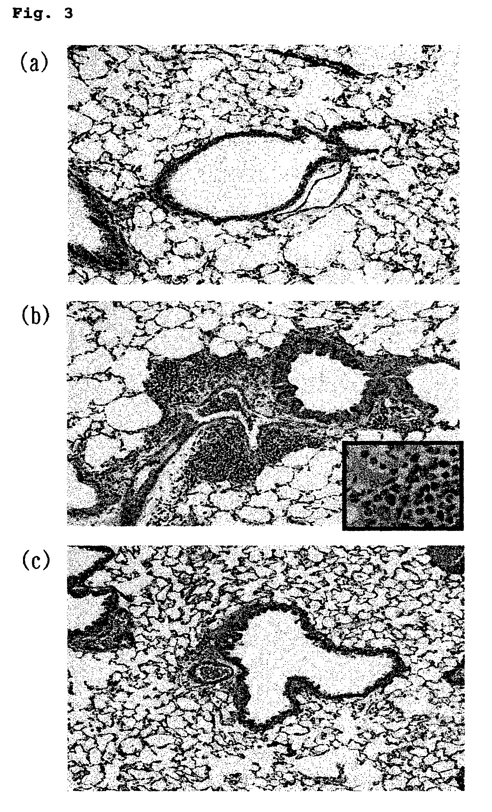 Asthma preparation