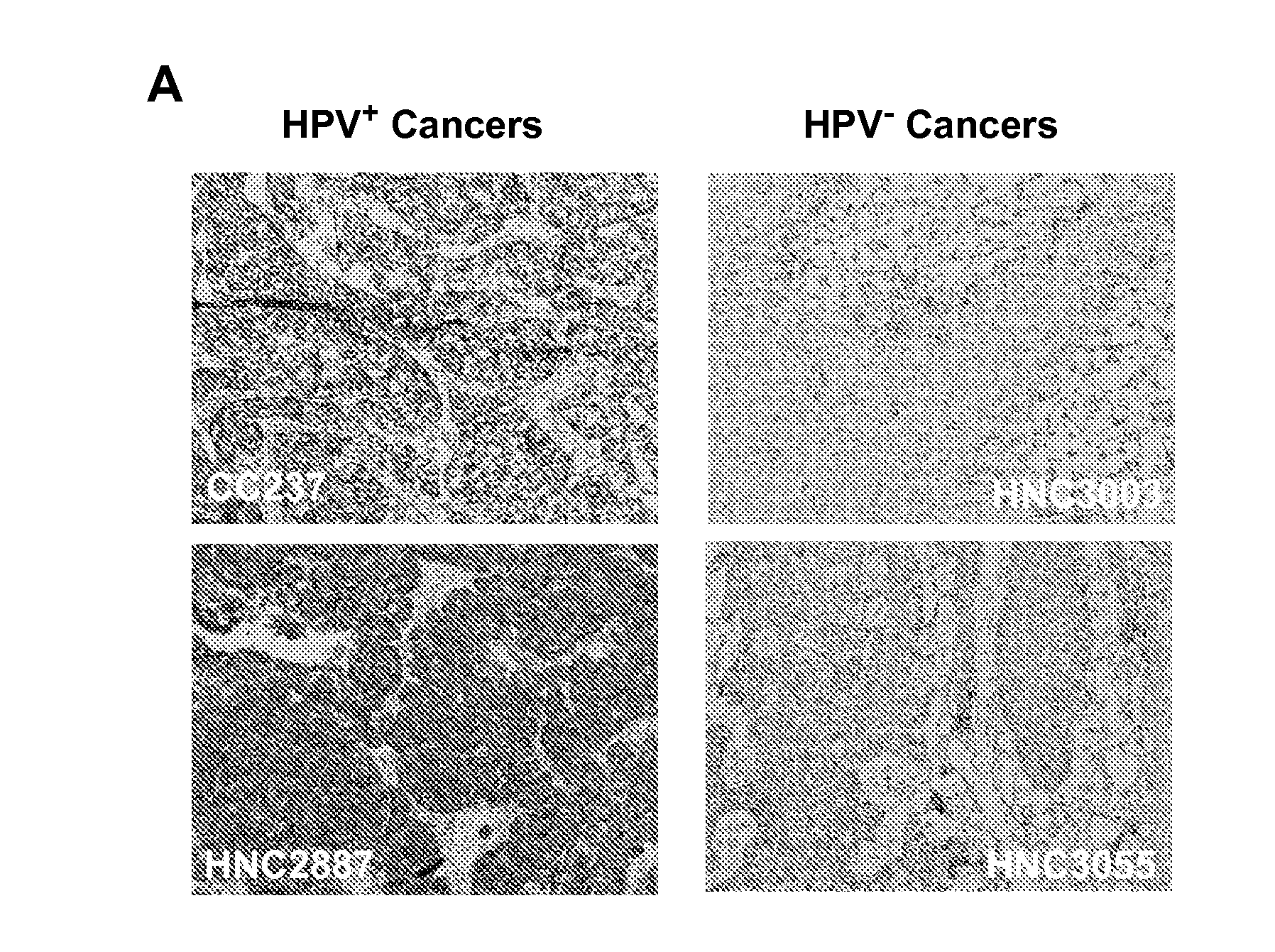 Biomarkers For Human Papilloma Virus-Associated Cancers