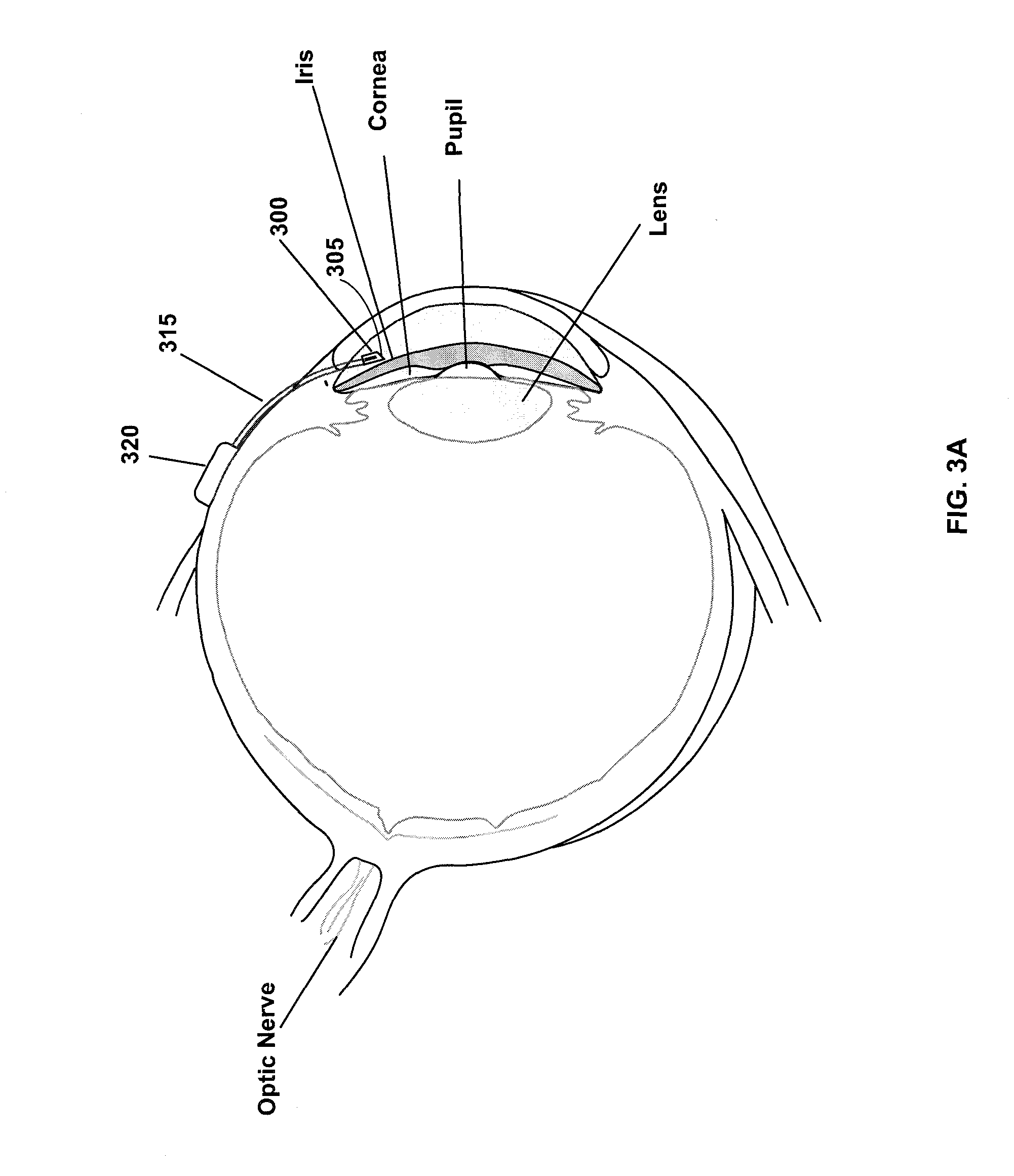 Ocular filtration devices, systems and methods