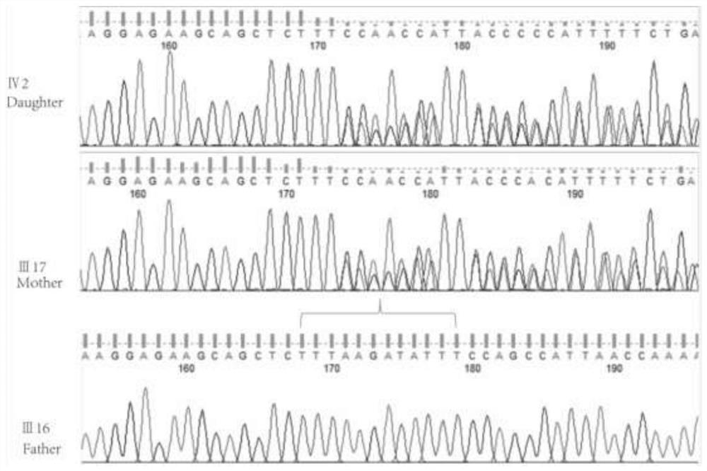 Mutant N4BP2 gene related to non-syndromic cleft lip and palate and application thereof