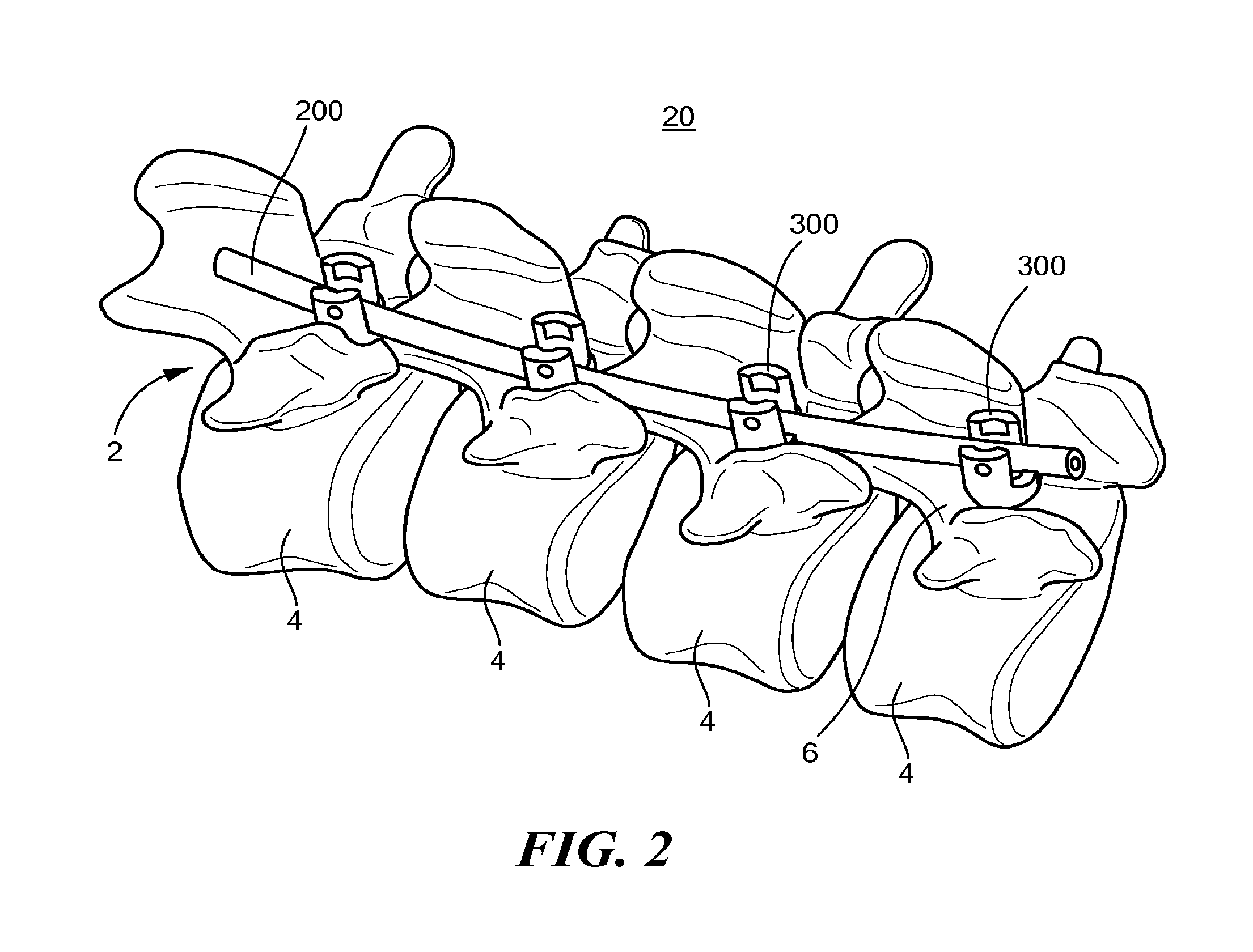 Minimally invasive spinal stabilization system