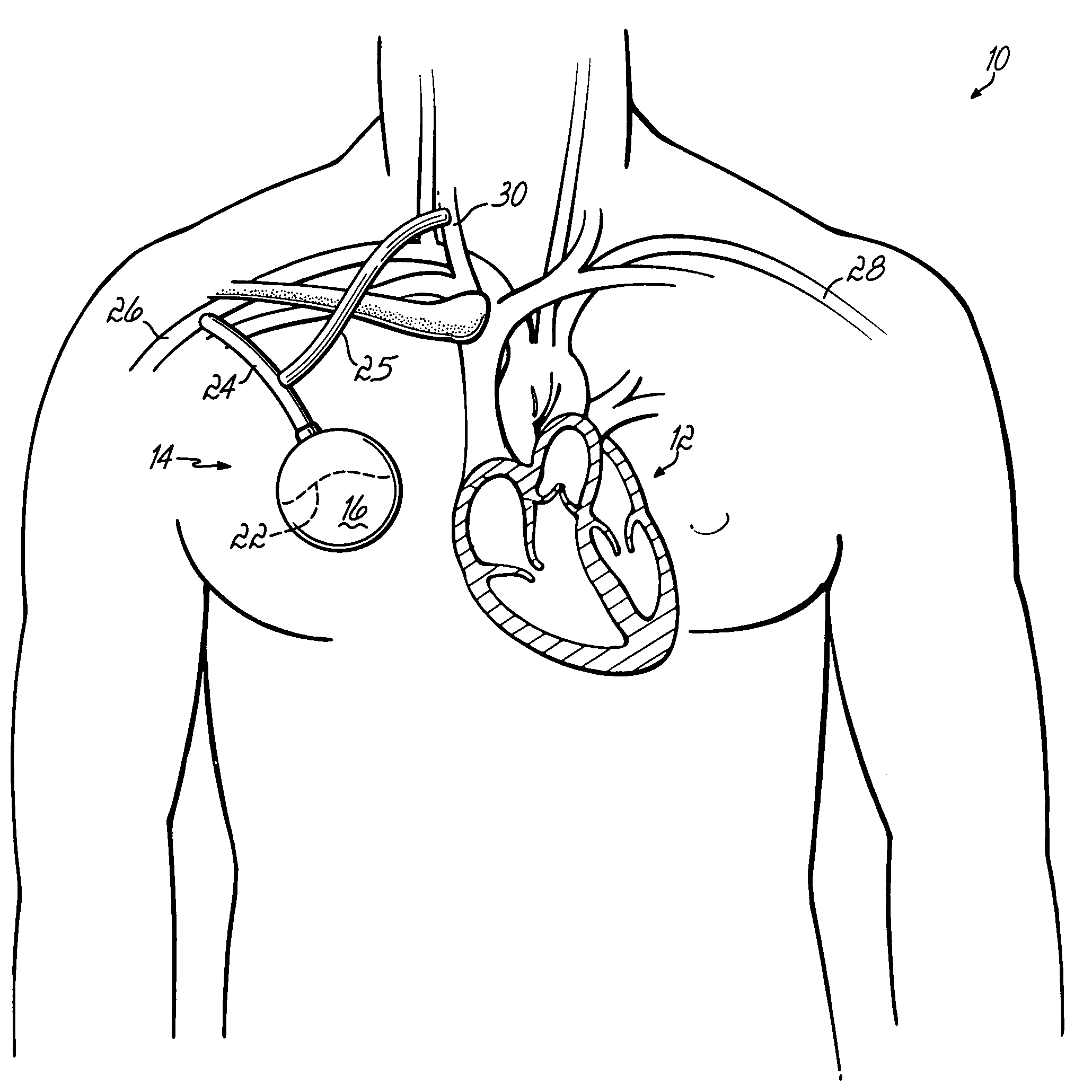 Methods, devices and systems for counterpulsation of blood flow to and from the circulatory system