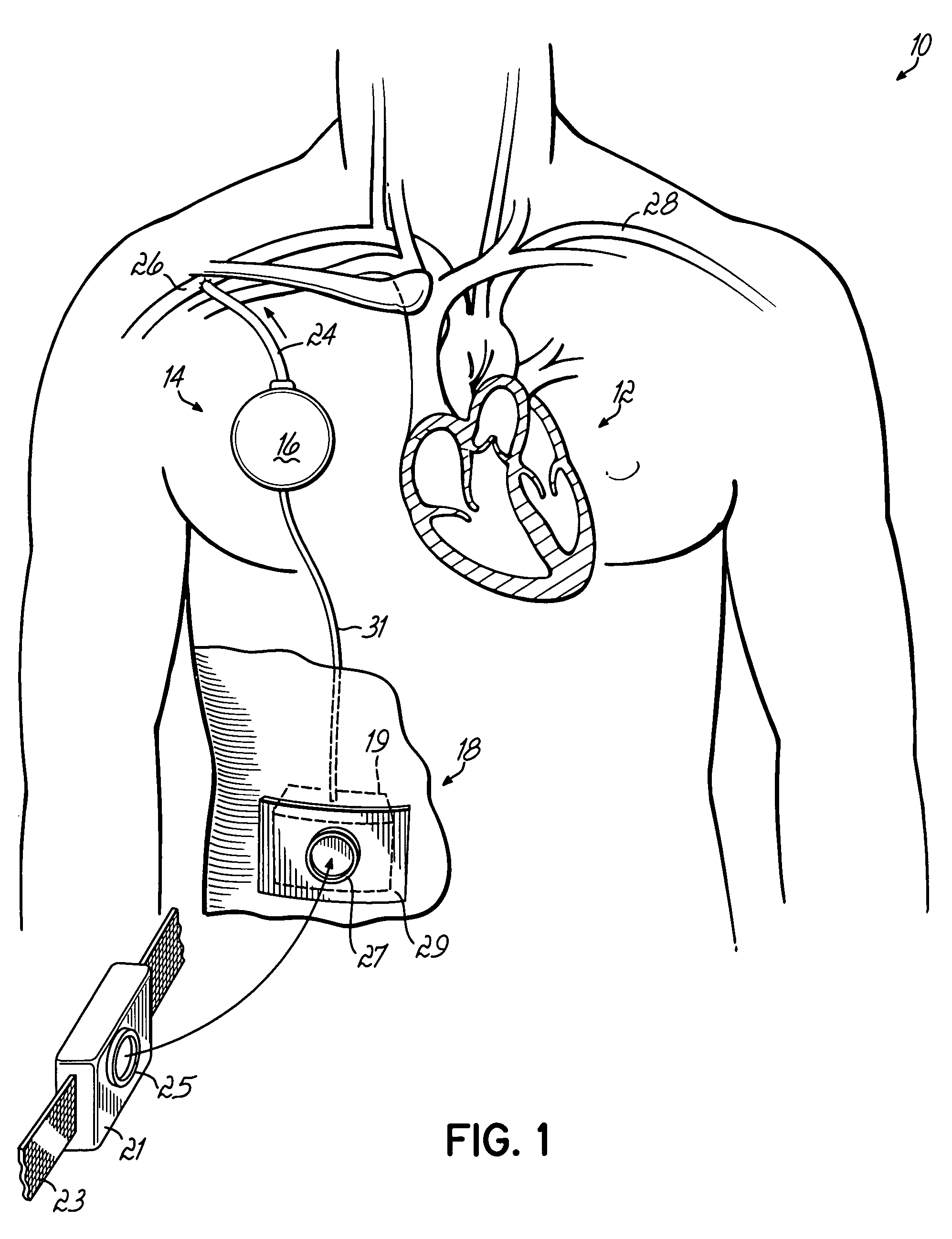 Methods, devices and systems for counterpulsation of blood flow to and from the circulatory system