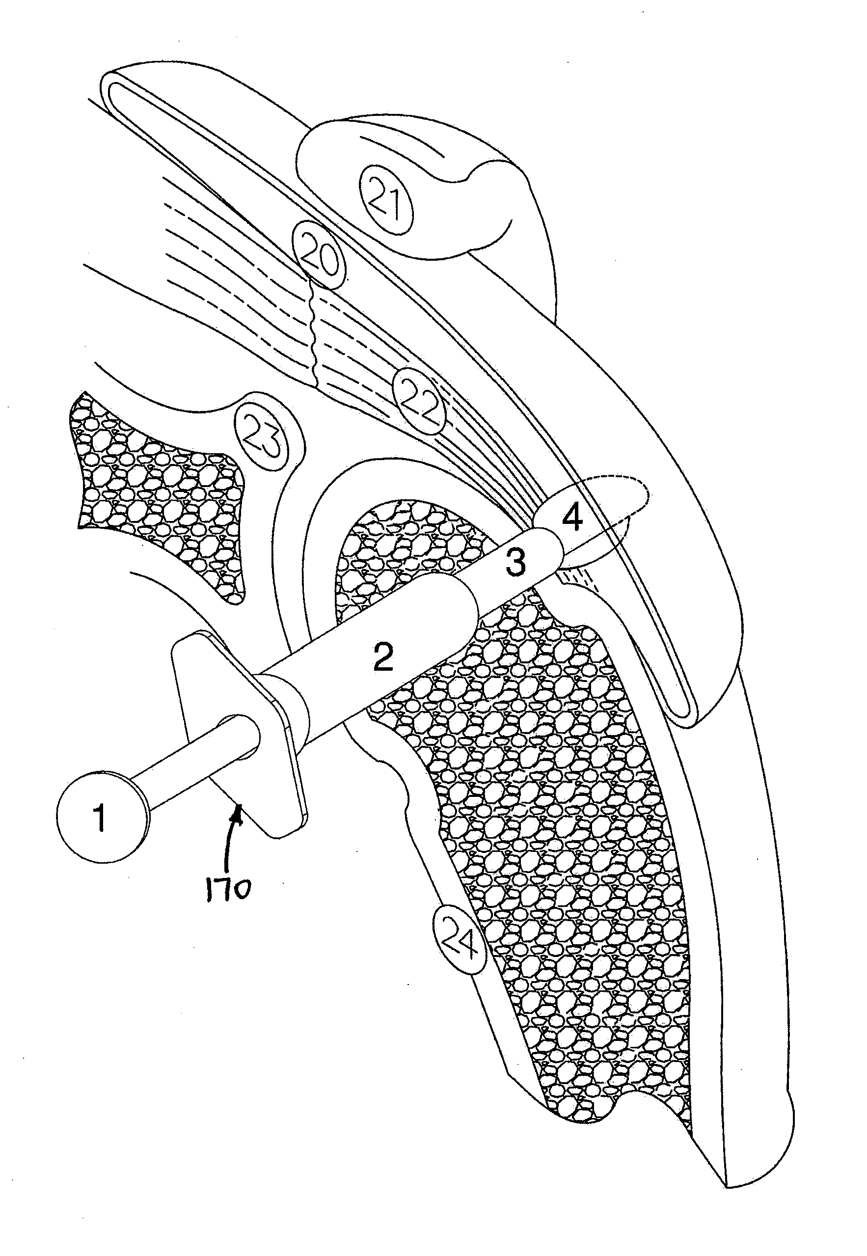 Implantable tendon protection systems and related kits and methods