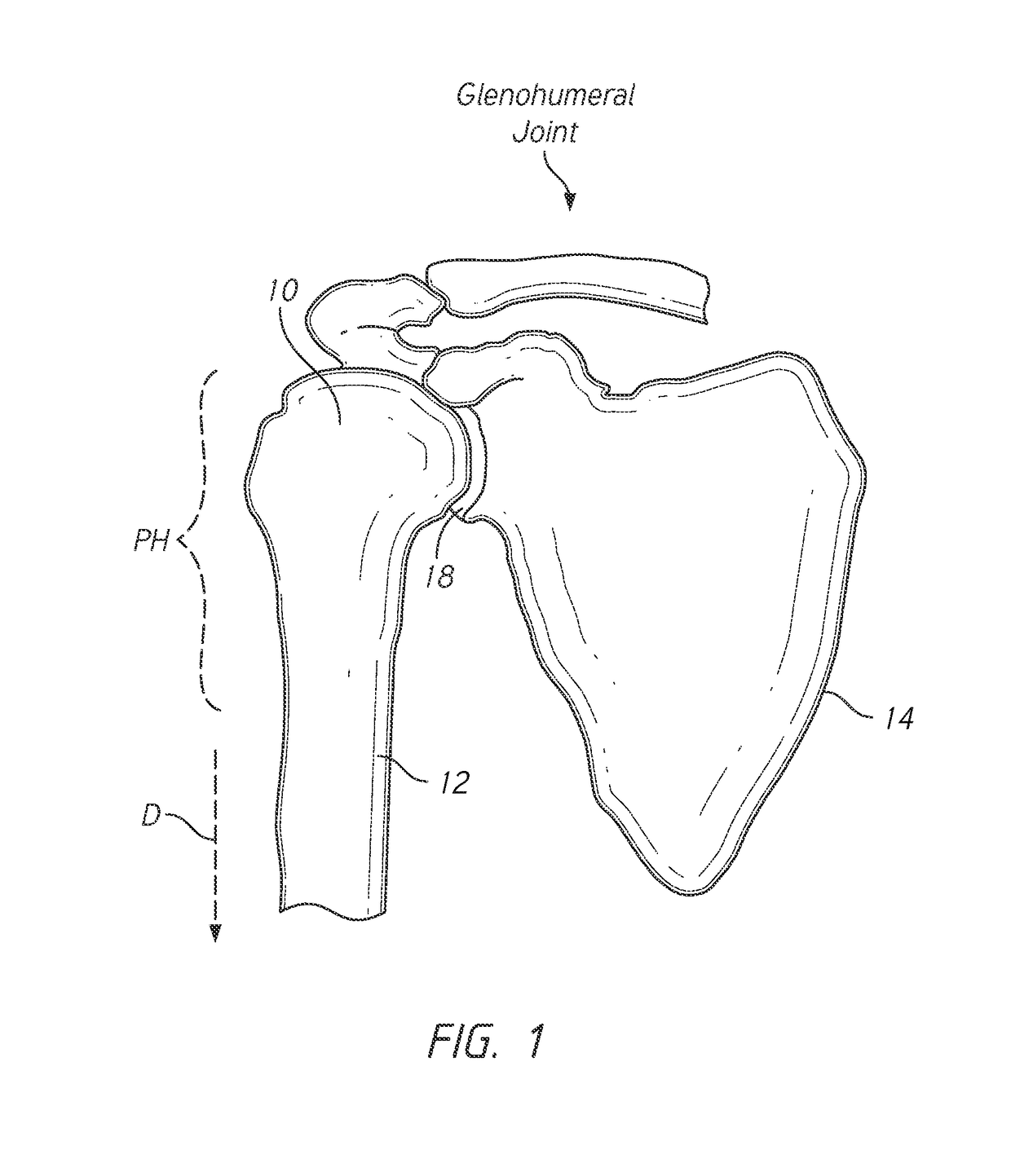 Patient specific humeral cutting guides