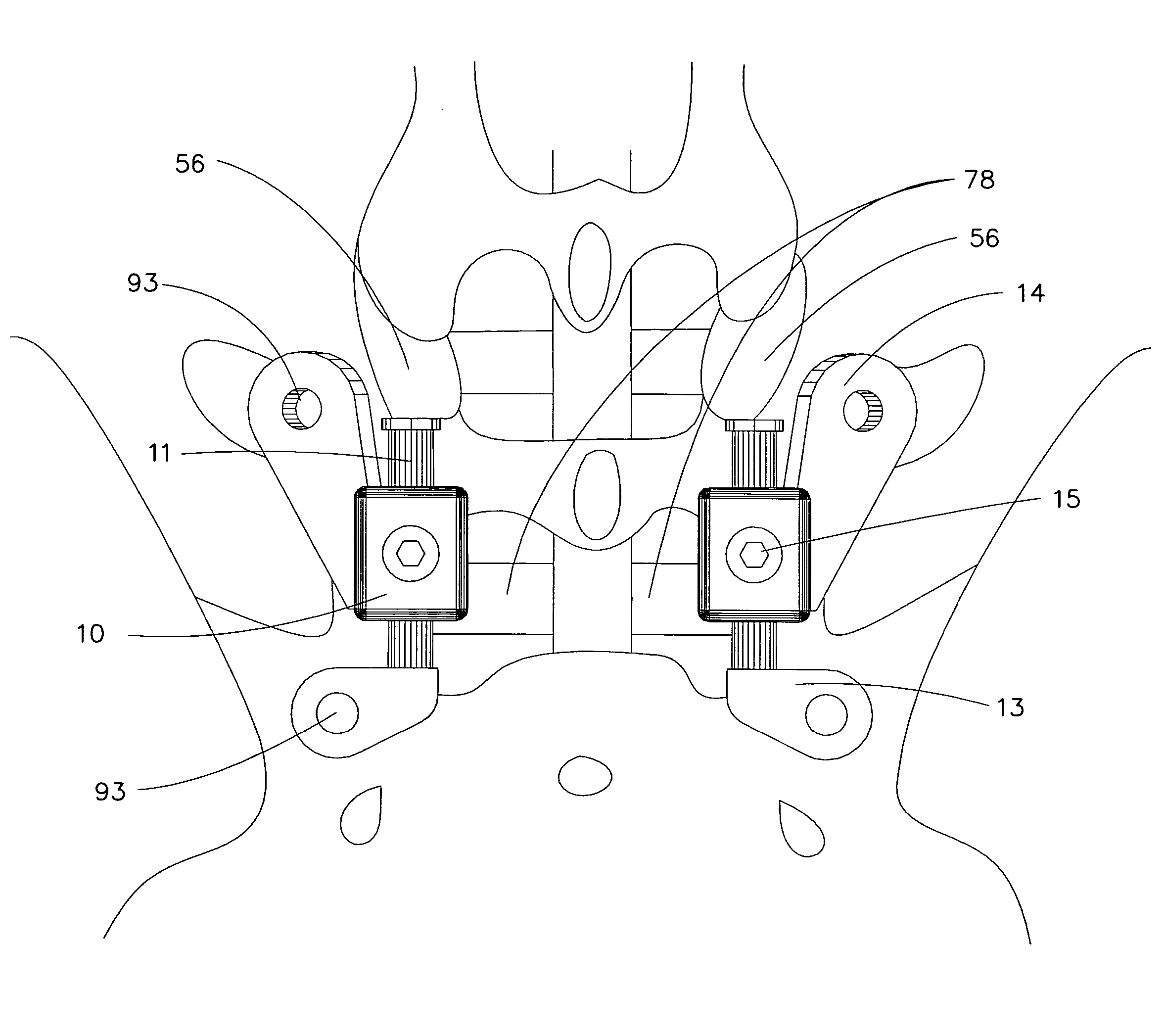 Posterior fixation system