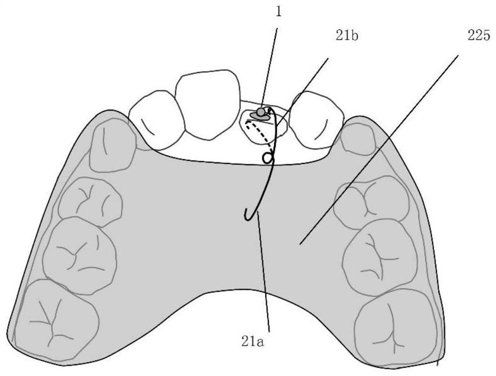 Embedded tooth traction device