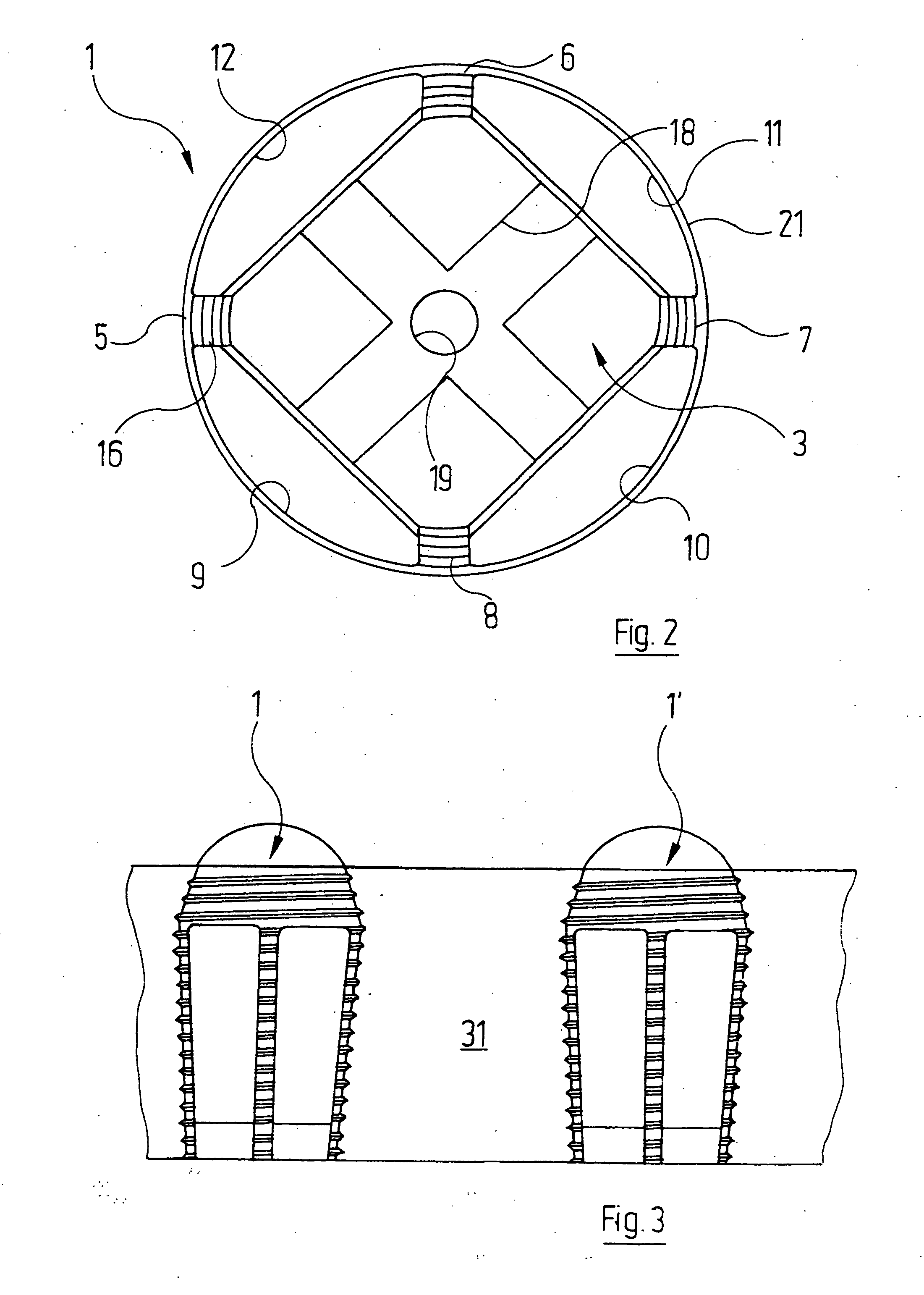 Intervertebral implant and surgical method for spondylodesis of a lumbar vertebral column