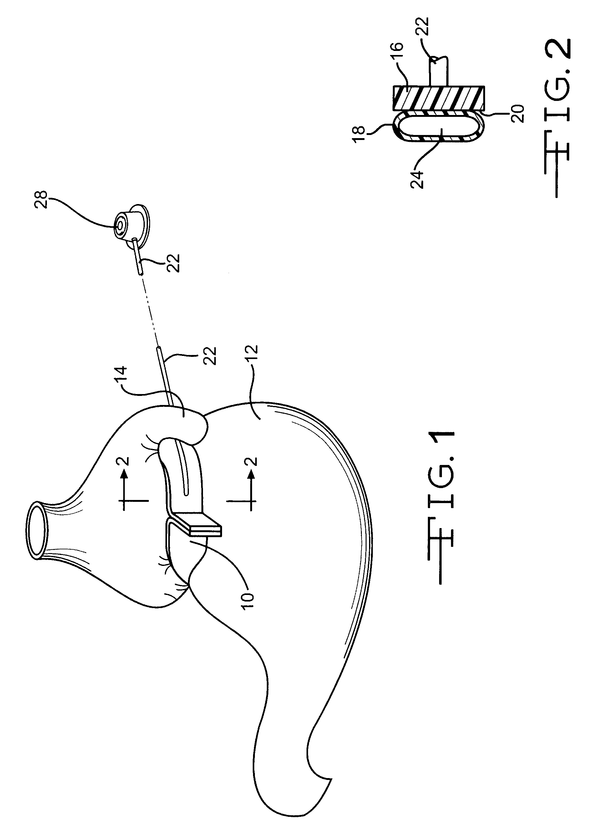 Implantable band with attachment mechanism