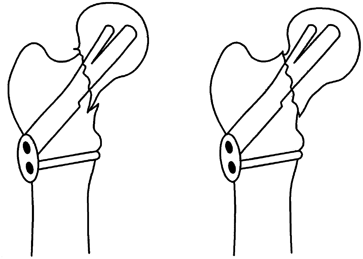 Bone fixation system