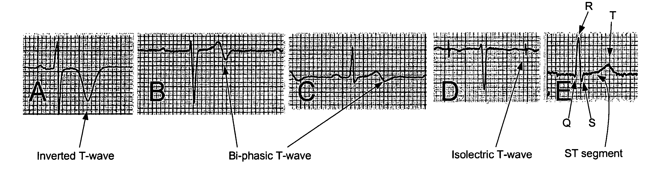 Differentiating ischemic from non-ischemic T-wave inversion