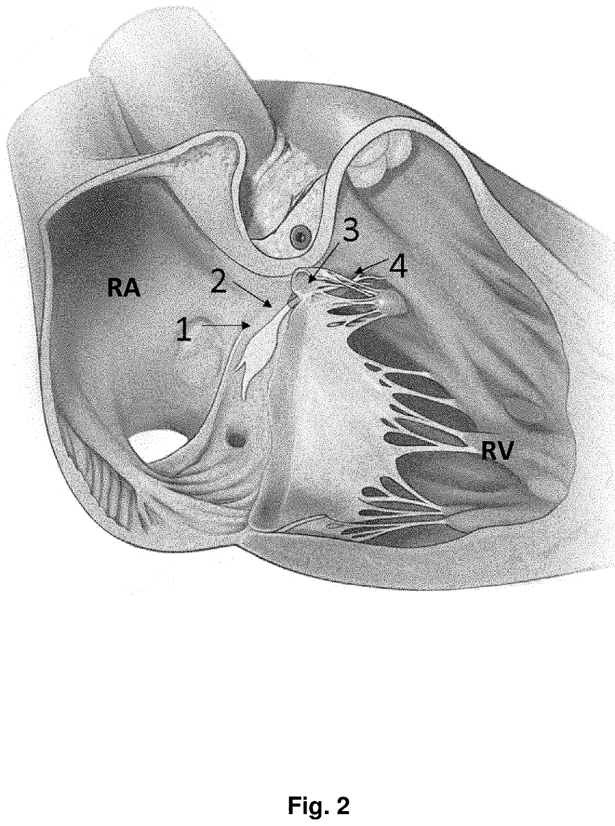 Leadless multi-electrode cardiac pacemakers and methods of implantation thereof