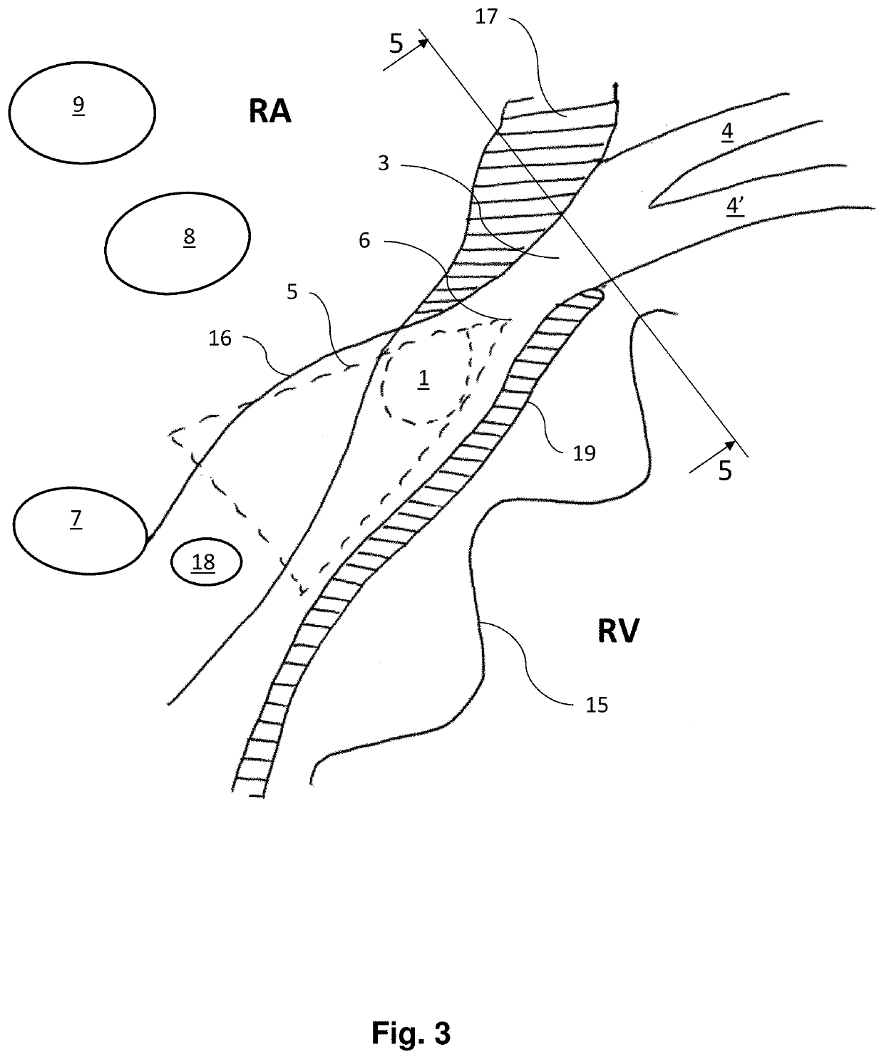 Leadless multi-electrode cardiac pacemakers and methods of implantation thereof