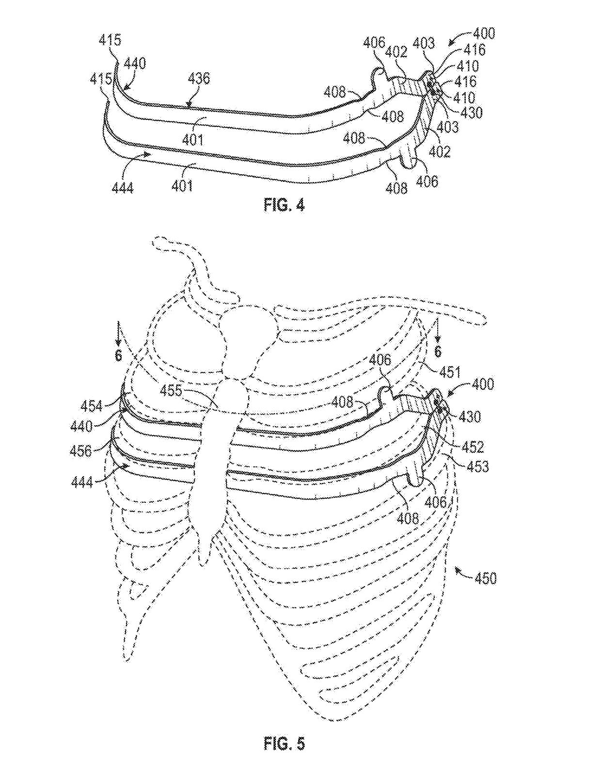 Apparatus and Methods For Treating Pectus Excavatum