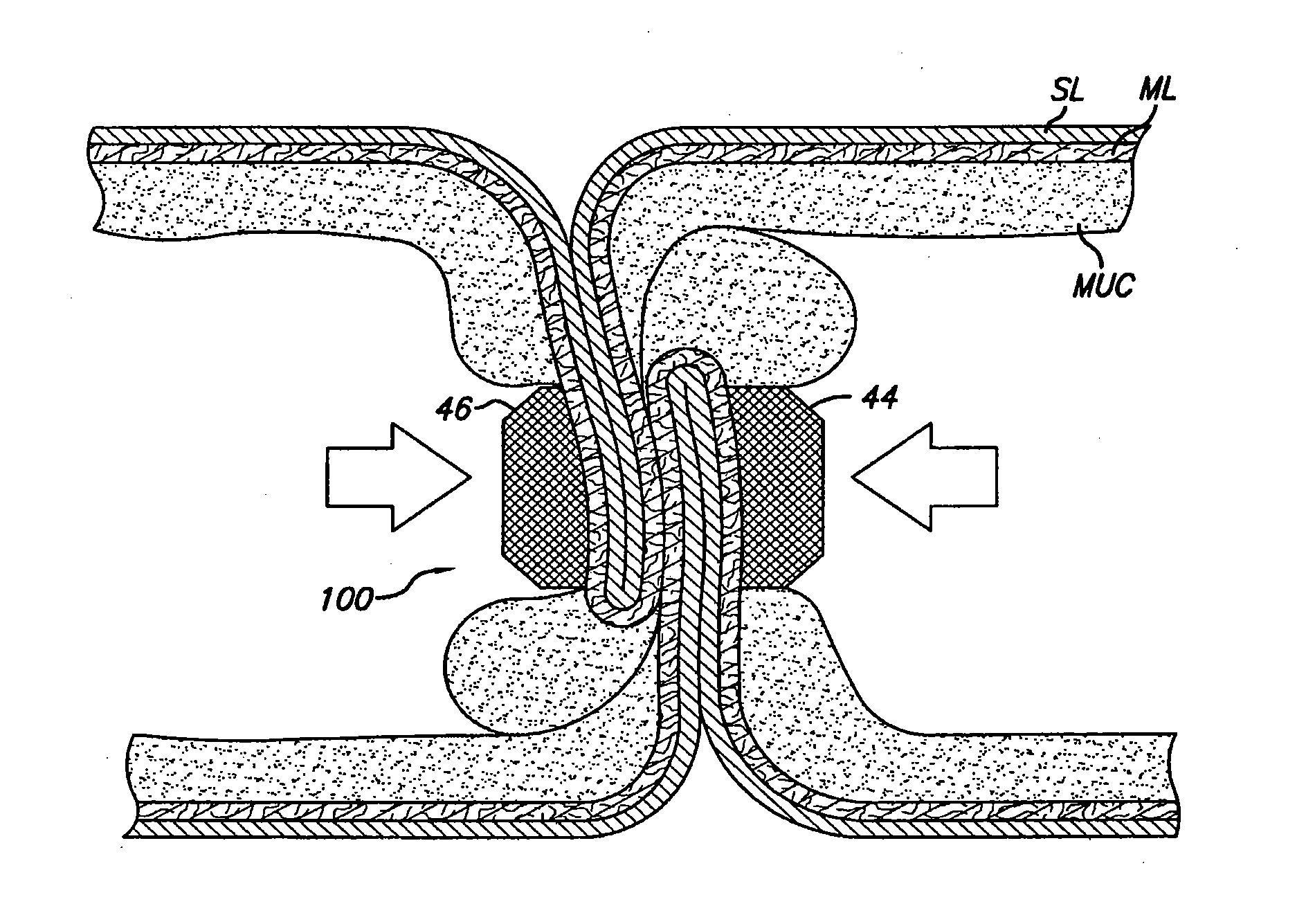 Single fold device for tissue fixation