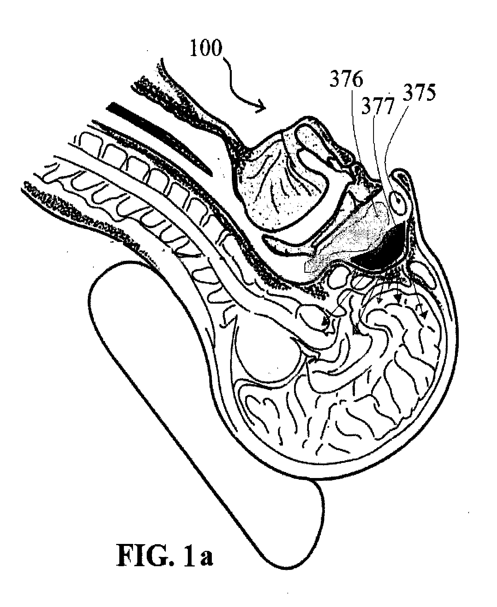 Alzheimer's disease treatment with multiple therapeutic agents delivered to the olfactory region through a special delivery catheter and iontophoresis