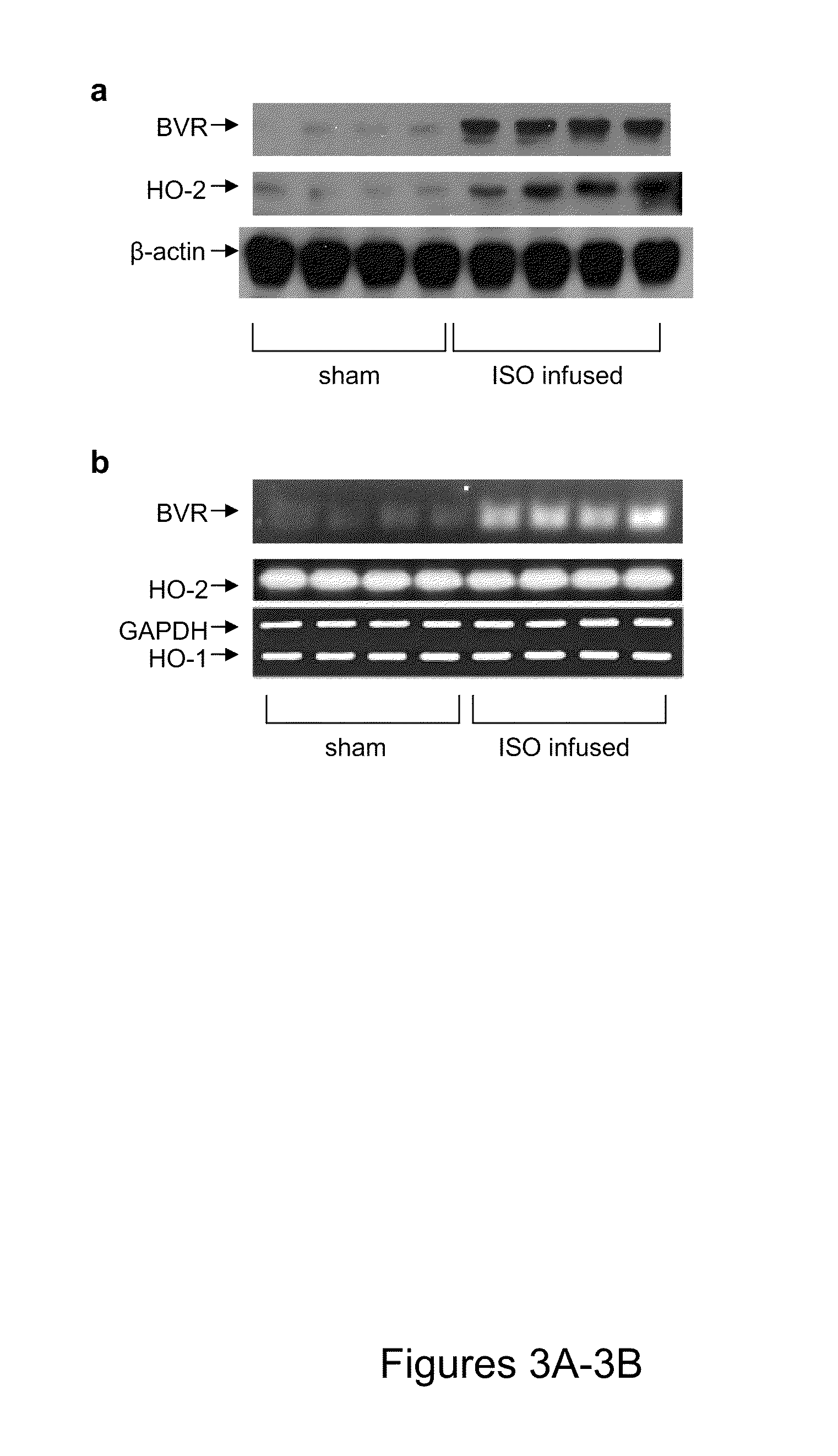 Use of biliverdin reductase (BVR) and bvr peptide fragments to treat coronary disorders