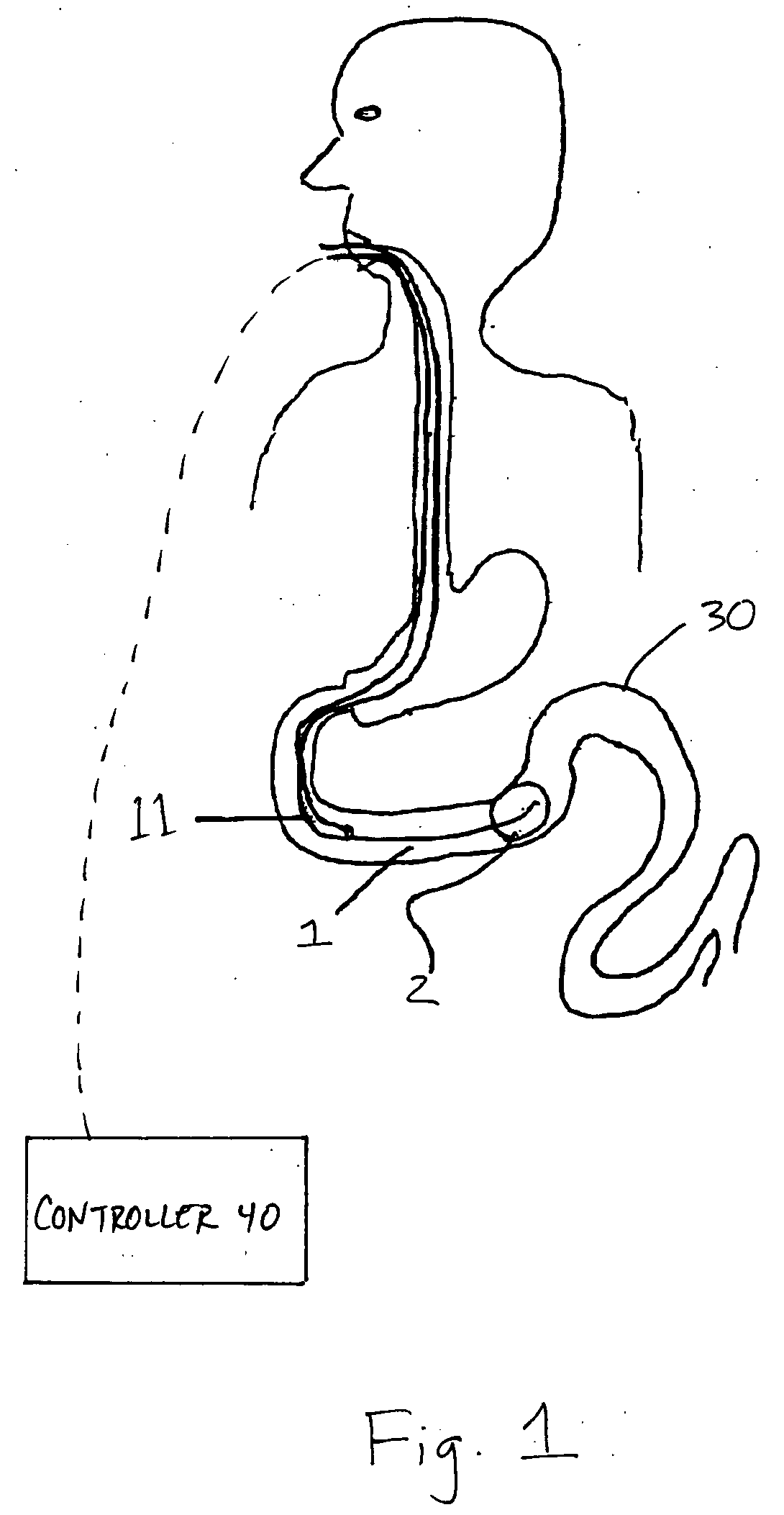 Intestinal ablation to limit food absorption