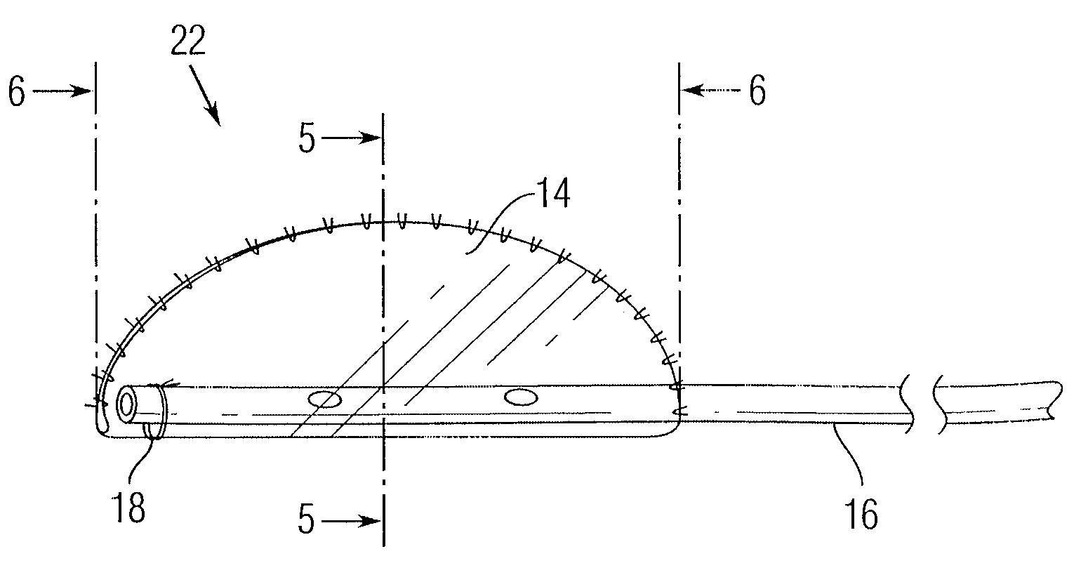 Implant for use in surgery for glaucoma and a method