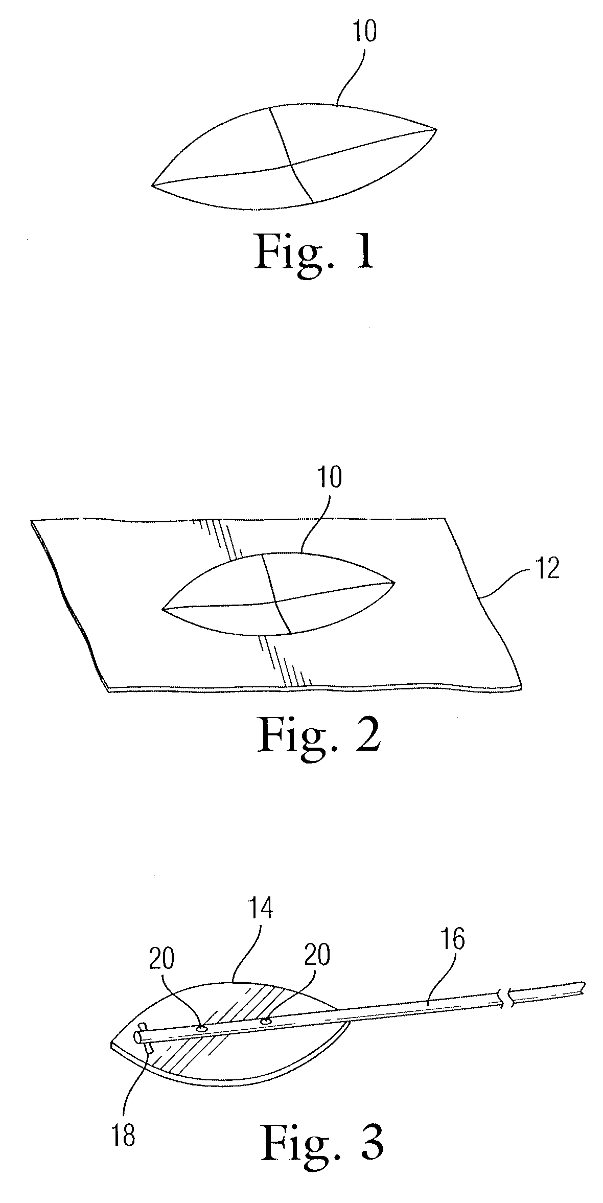 Implant for use in surgery for glaucoma and a method