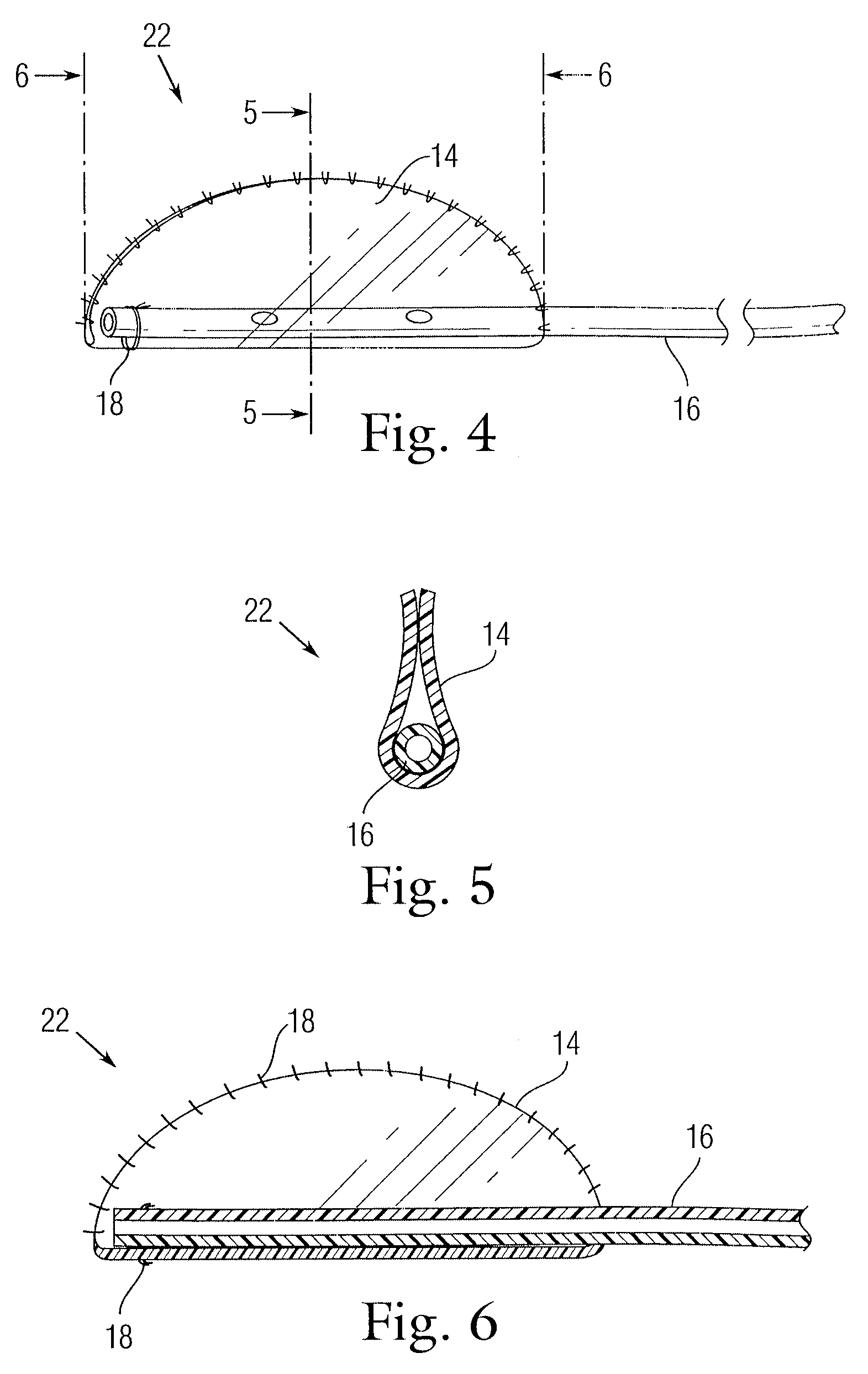 Implant for use in surgery for glaucoma and a method