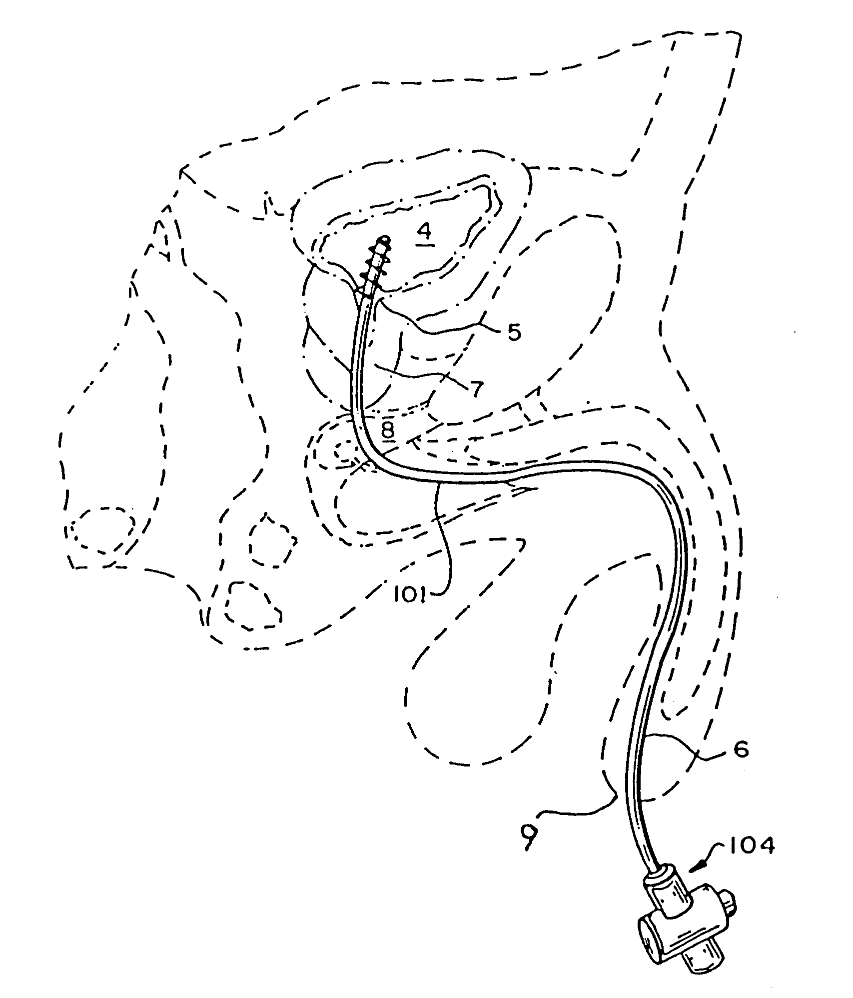 Rotate-to-advance catheterization system