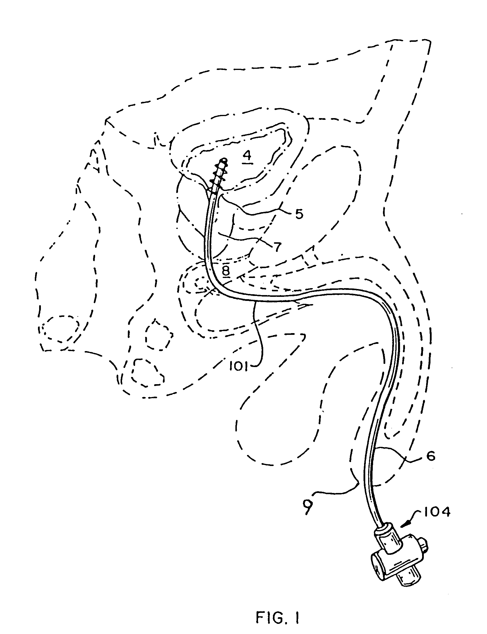 Rotate-to-advance catheterization system