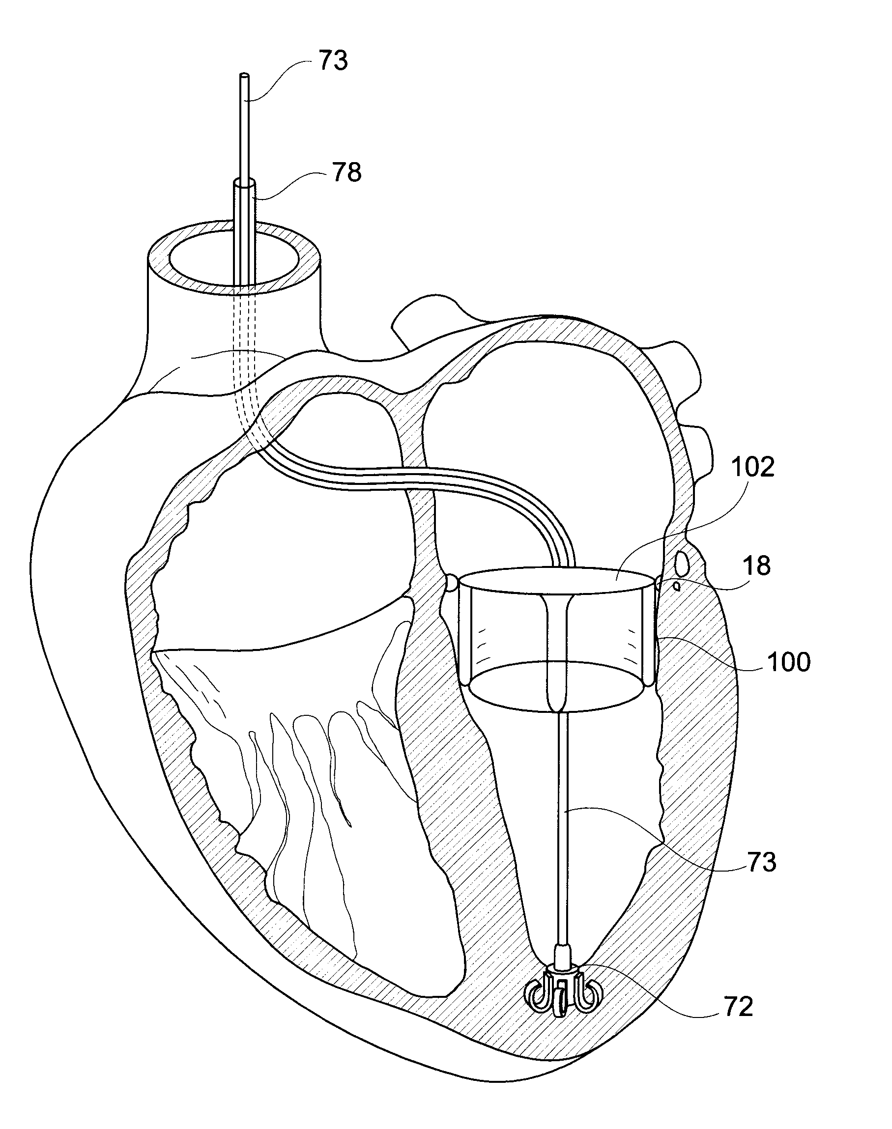 Device And A Method For Augmenting Heart Function