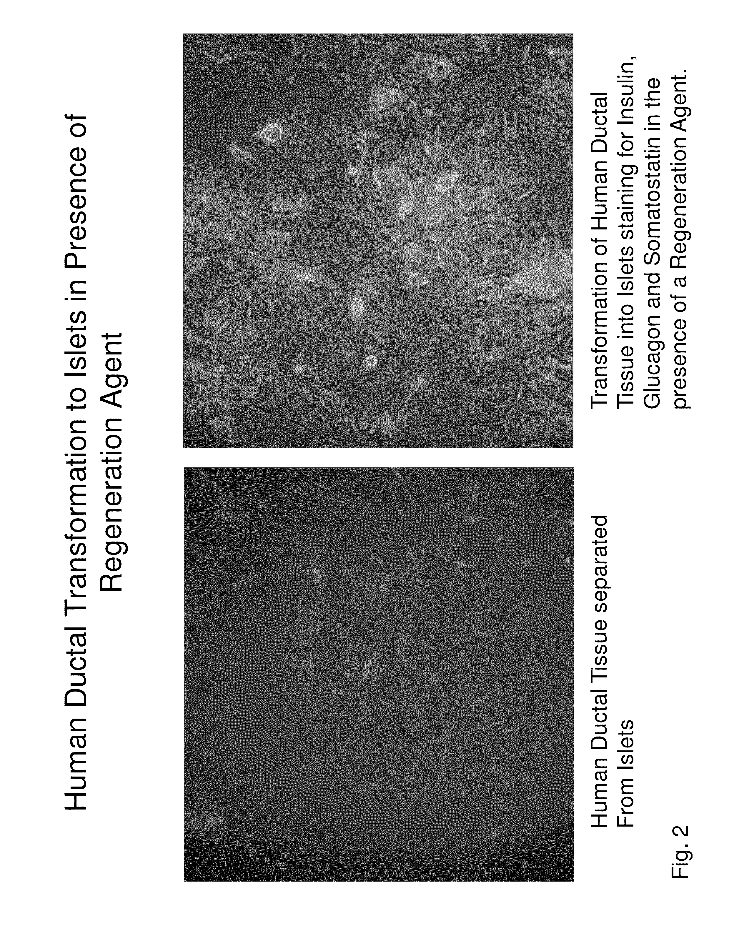 Insulin independence among patients with diabetes utilizing a PPI in combination with an immune tolerance agent