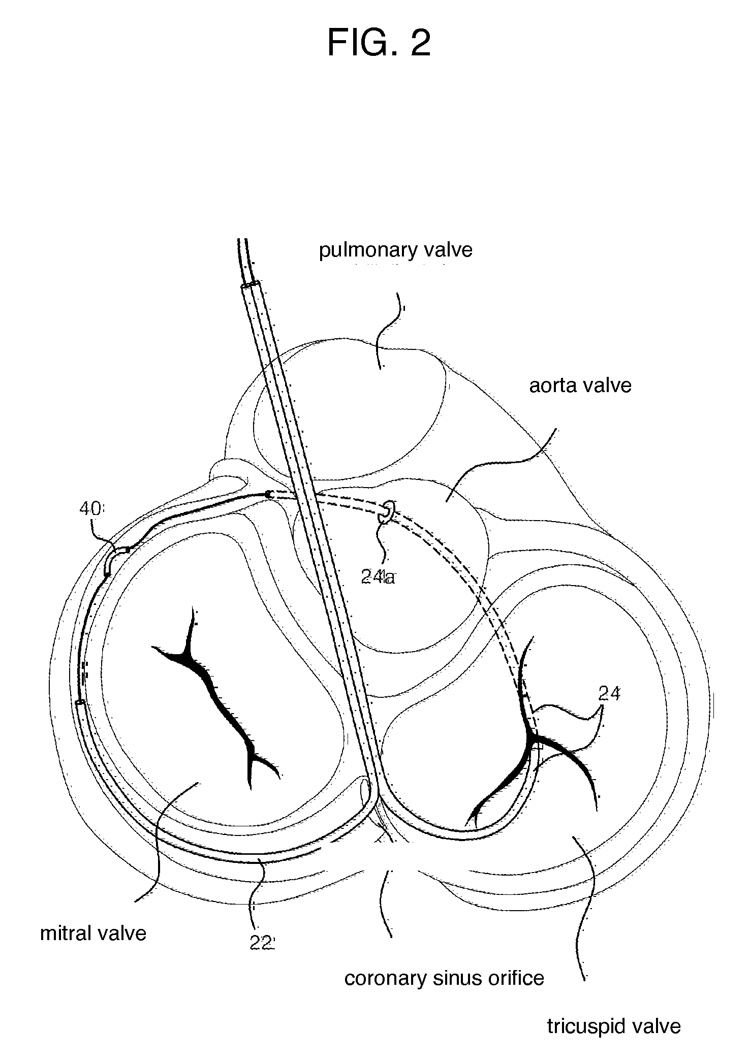 Mitral cerclage annuloplasty apparatus