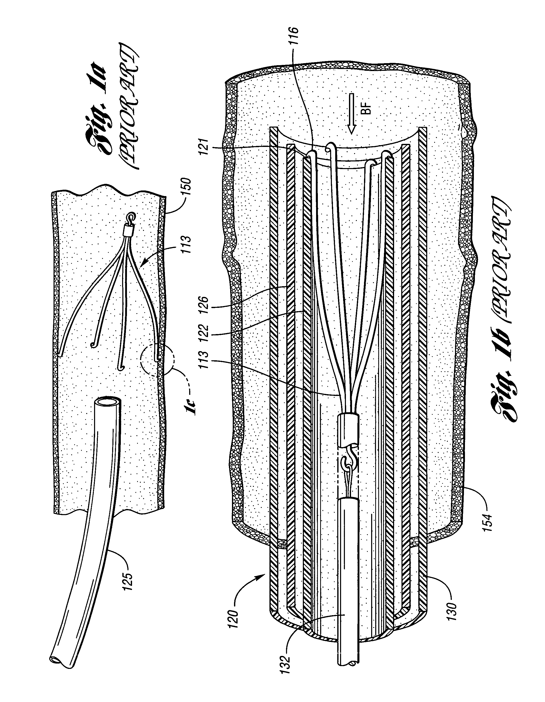 Removable vena cava filter for reduced trauma in collapsed configuration