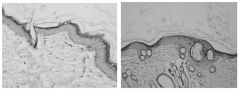 A composite collagen dressing for repairing difficult-to-heal wounds and its preparation method