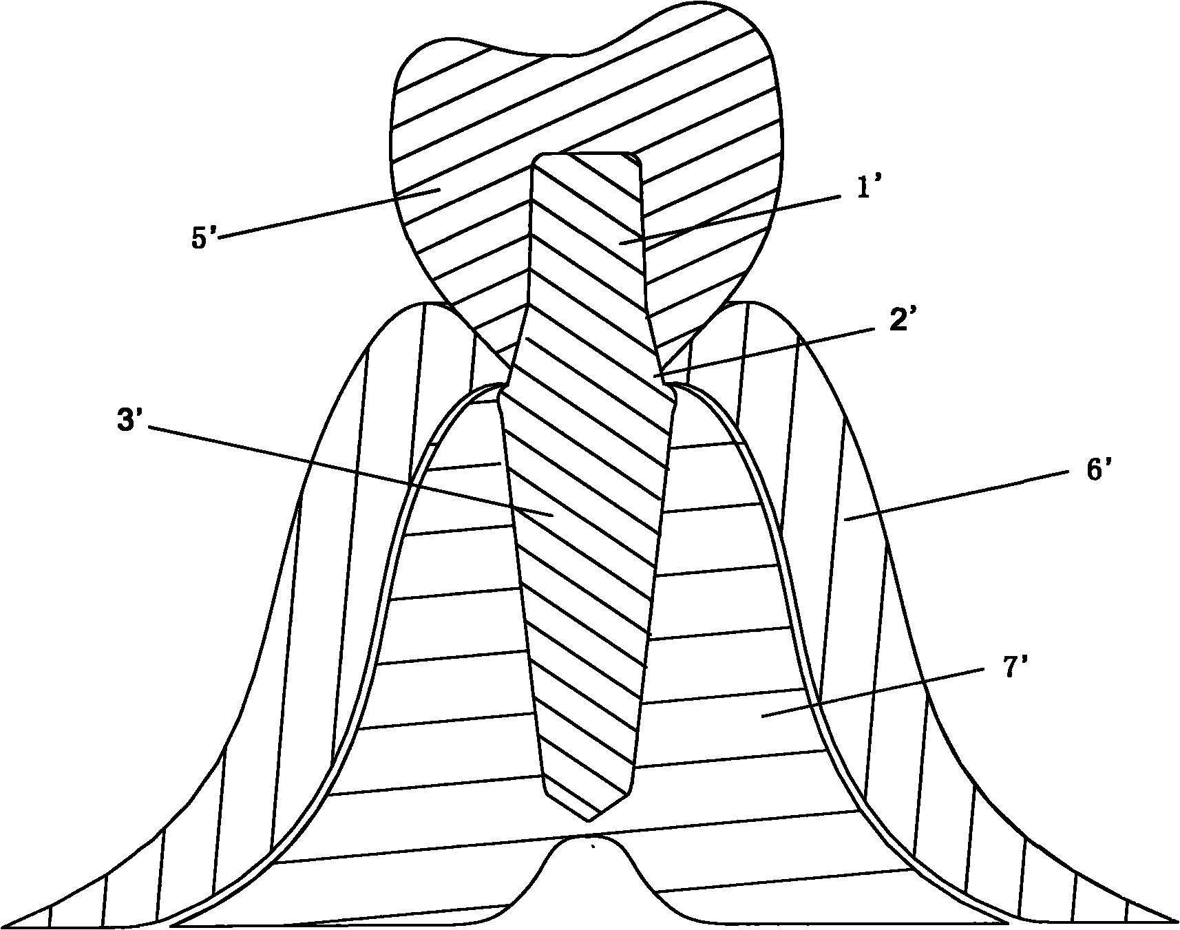 Single-tooth residual root implant