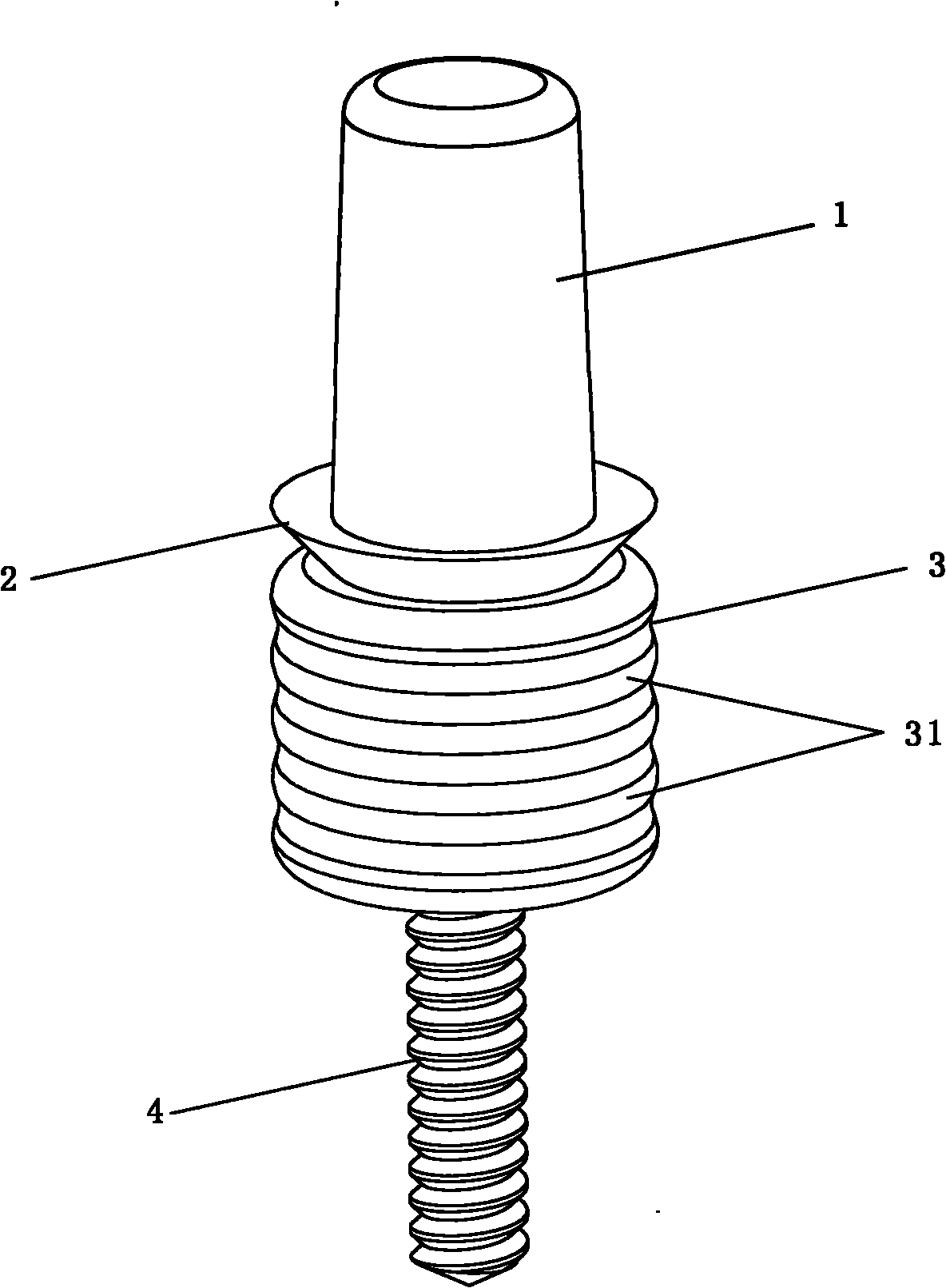 Single-tooth residual root implant