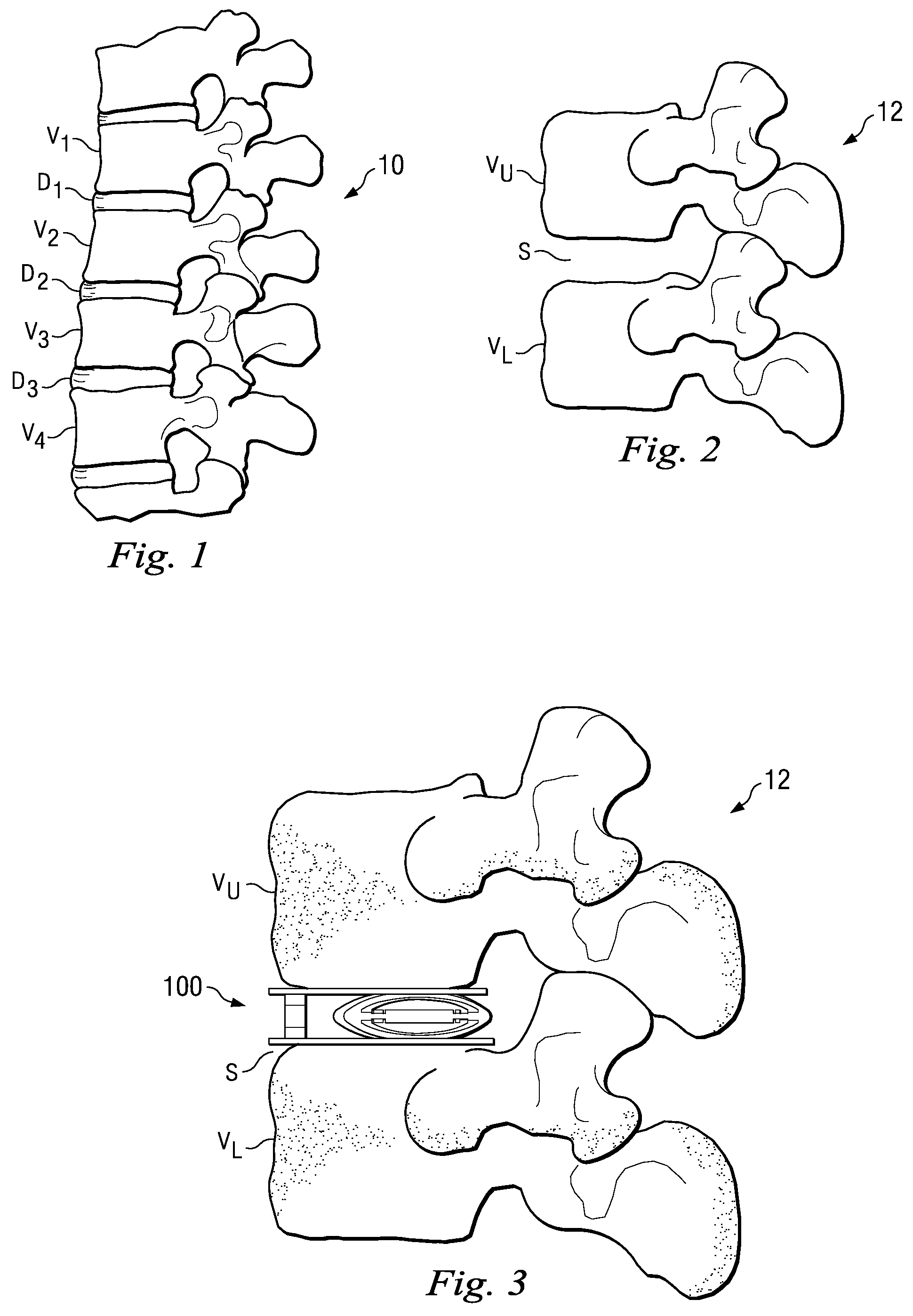 Active Vertebral Prosthetic Device