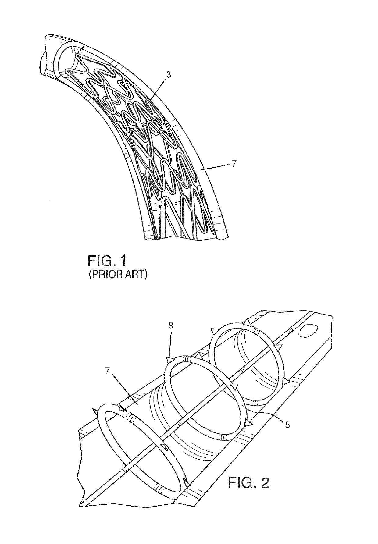 Endovascular implant