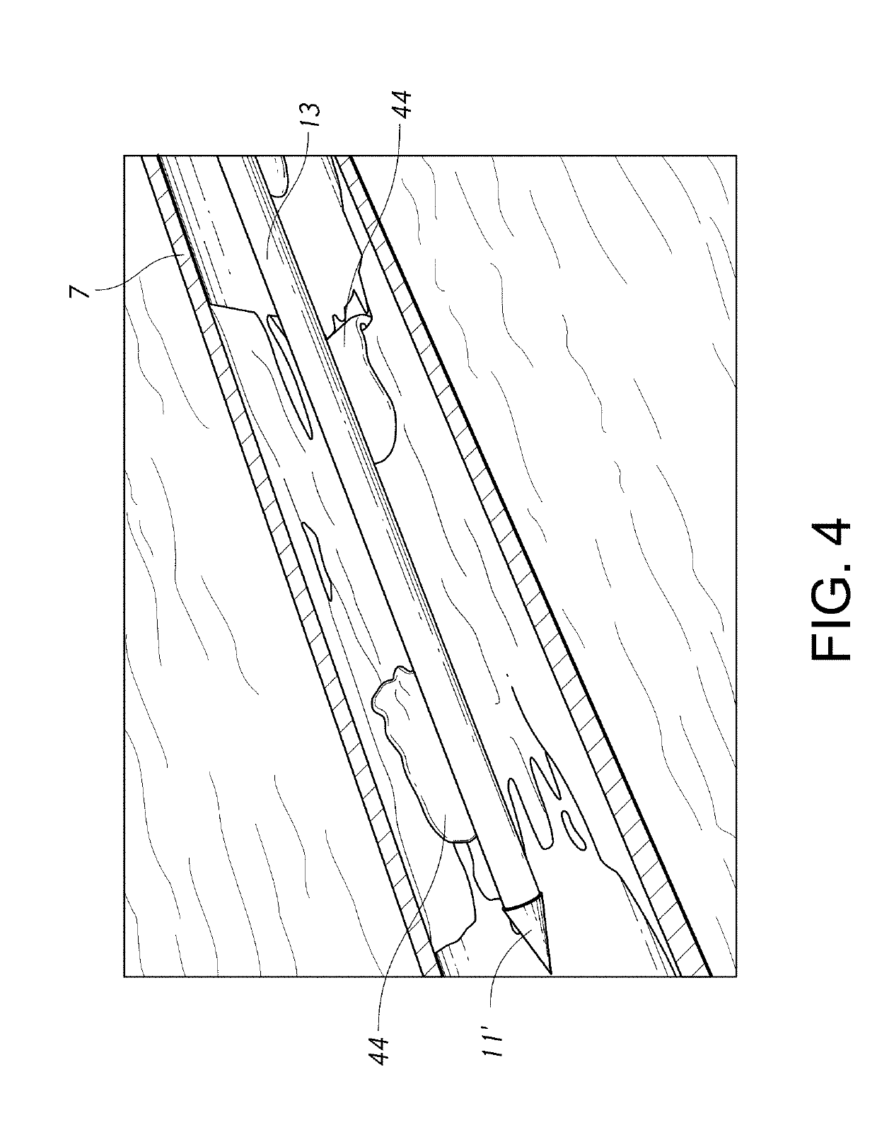 Endovascular implant