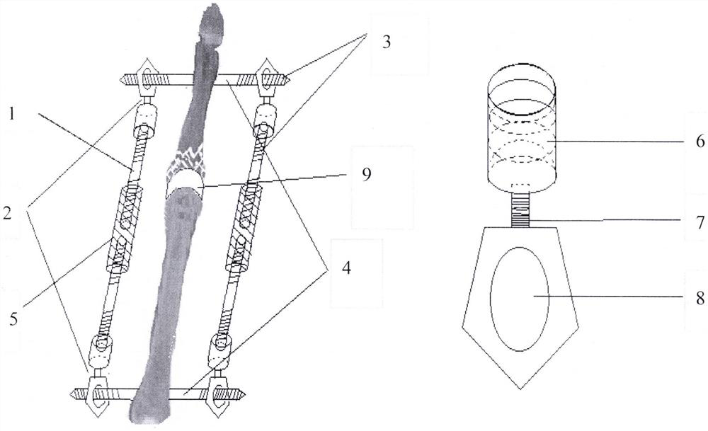 Miniature external fixation combined frame for treating interphalangeal joint comminuted fracture (pion fracture) of hands