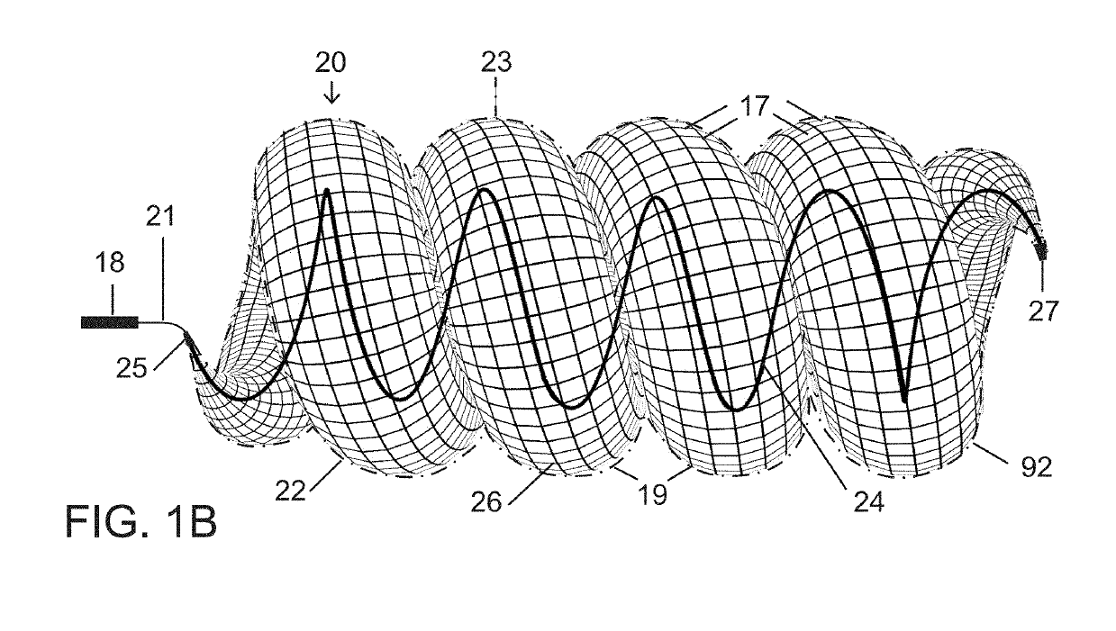 Micro-Macro Endovascular Occlusion Device and Methodology