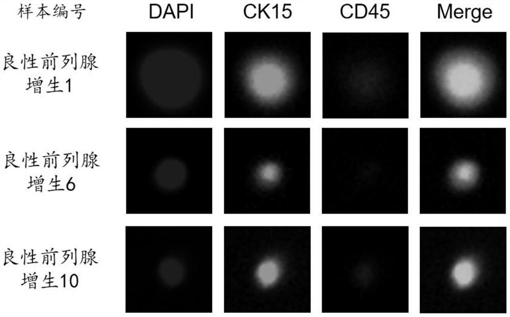 Immunofluorescence kit for detecting circulating prostate epithelial cells in blood and use method of immunofluorescence kit