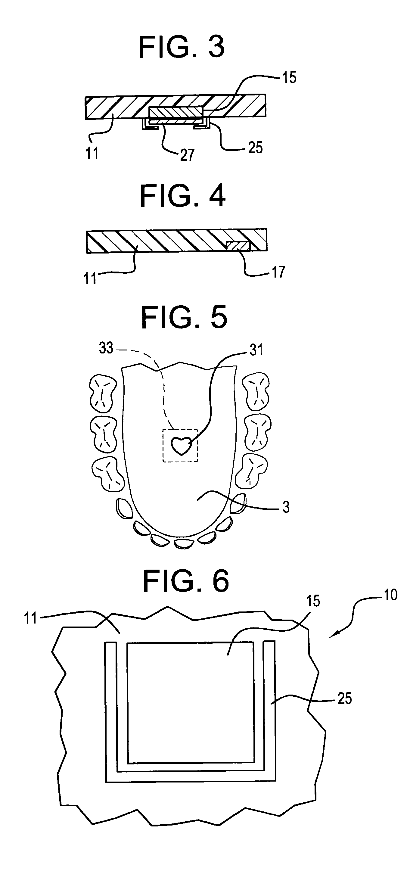 Illuminated orthodontic retainer