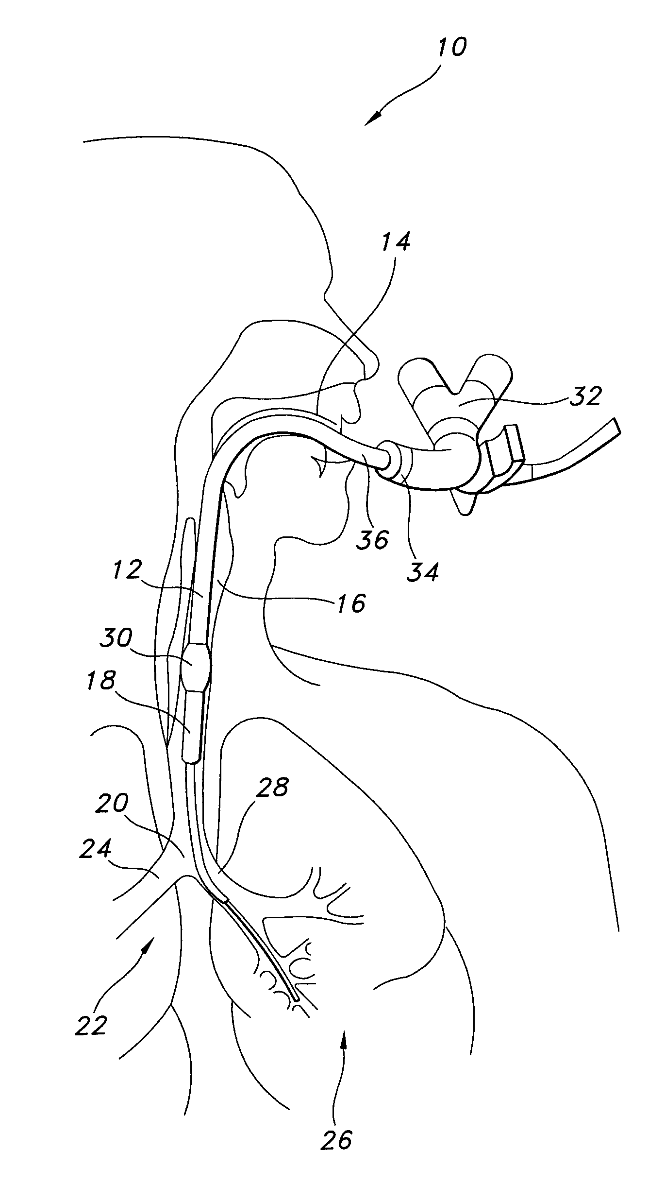 Multilumen tracheal catheter to prevent cross contamination